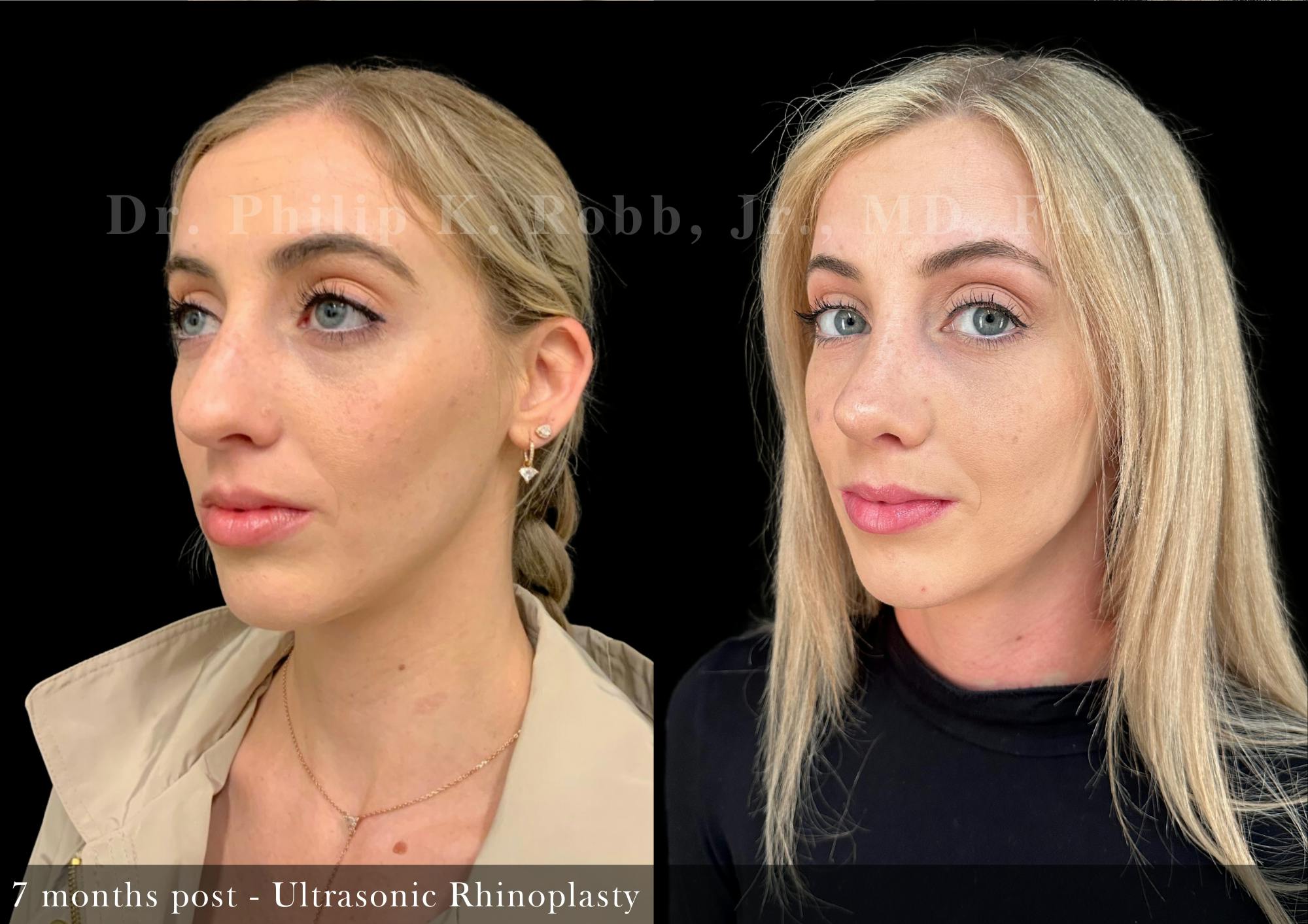 Nose Before & After Gallery - Patient 862654 - Image 5