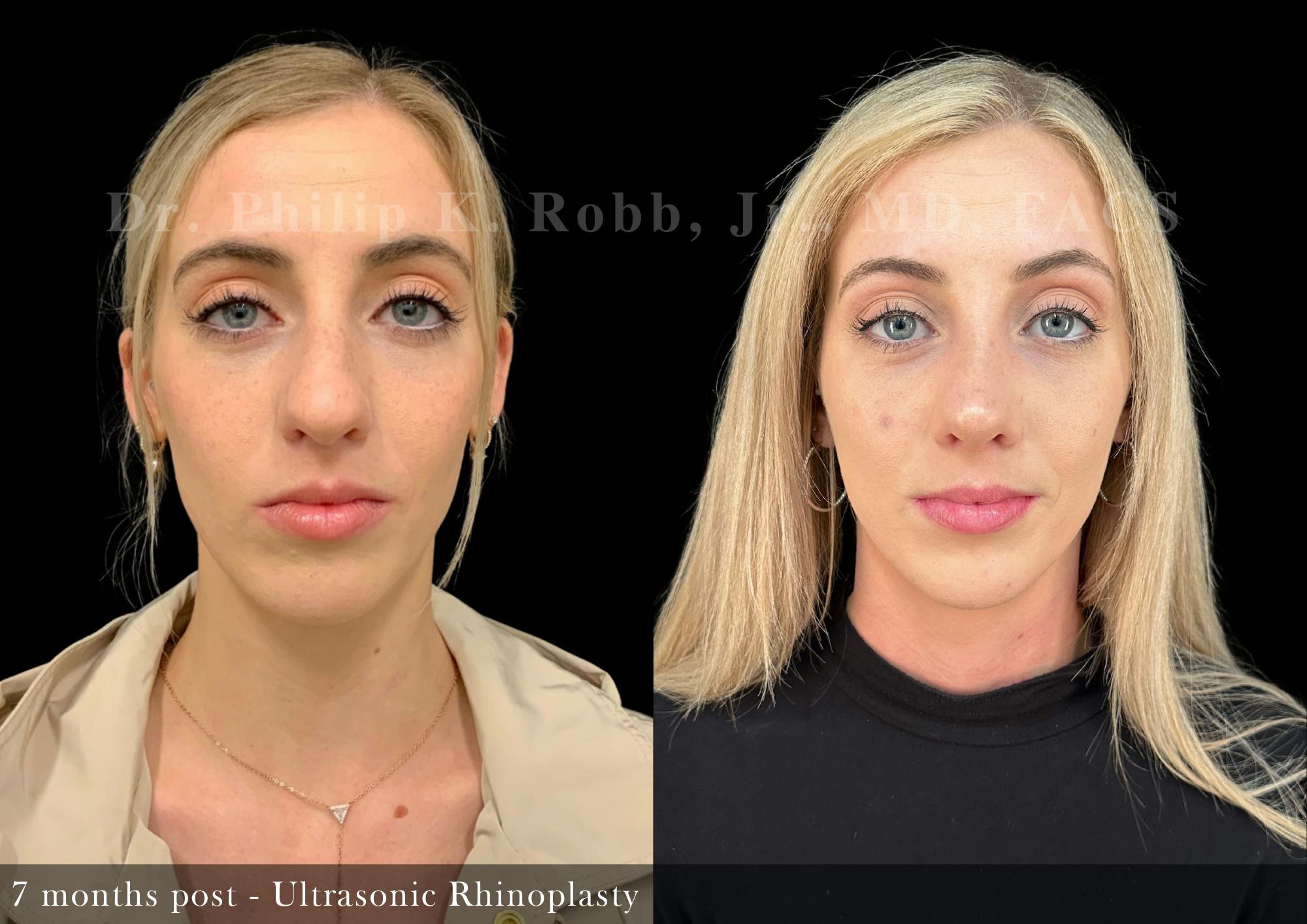 Nose Before & After Gallery - Patient 862654 - Image 4