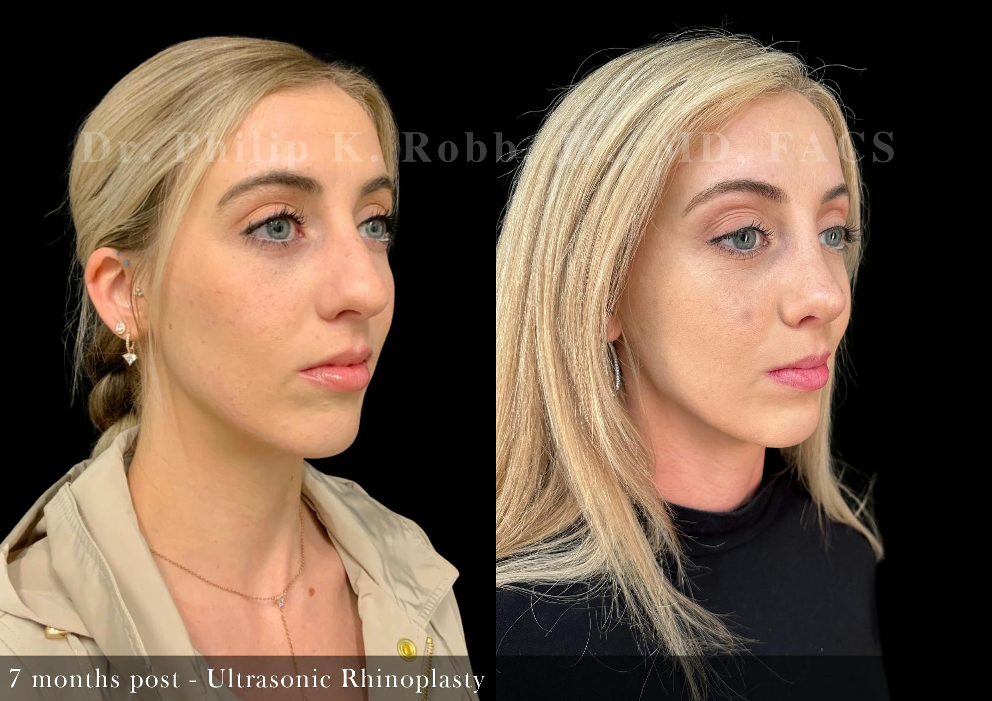 Nose Before & After Gallery - Patient 862654 - Image 2