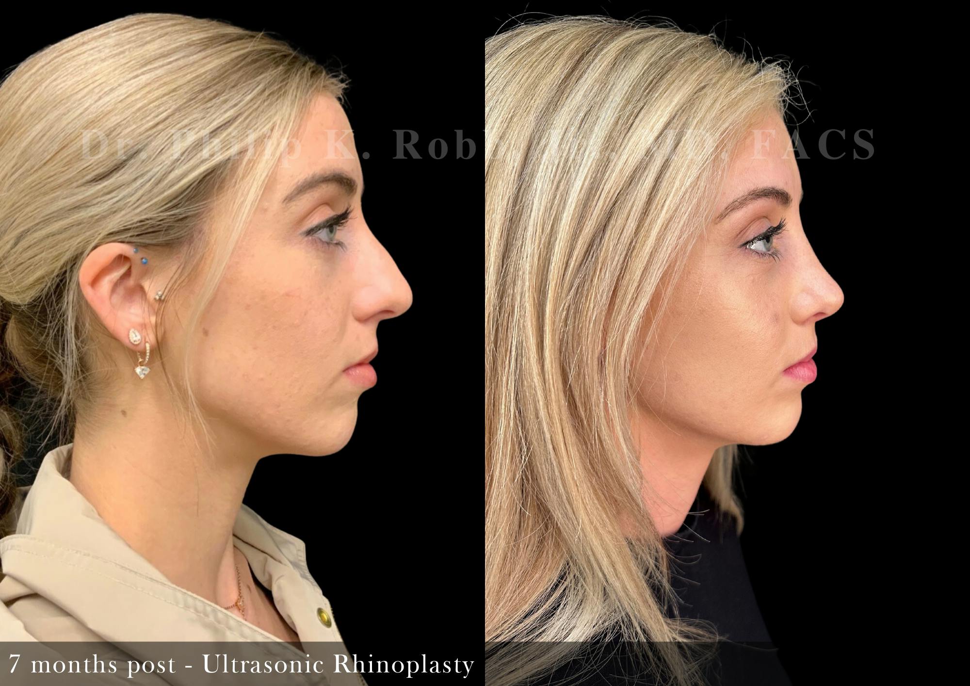 Nose Before & After Gallery - Patient 862654 - Image 1