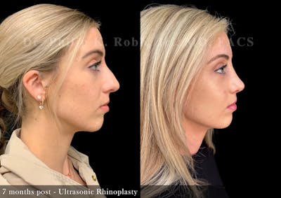 Nose Before & After Gallery - Patient 862654 - Image 1