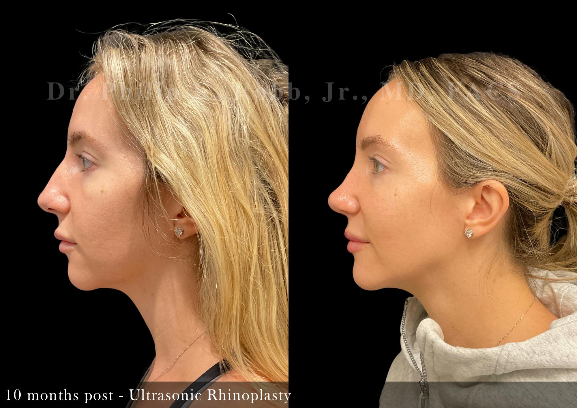 Nose Before & After Gallery - Patient 108882 - Image 4