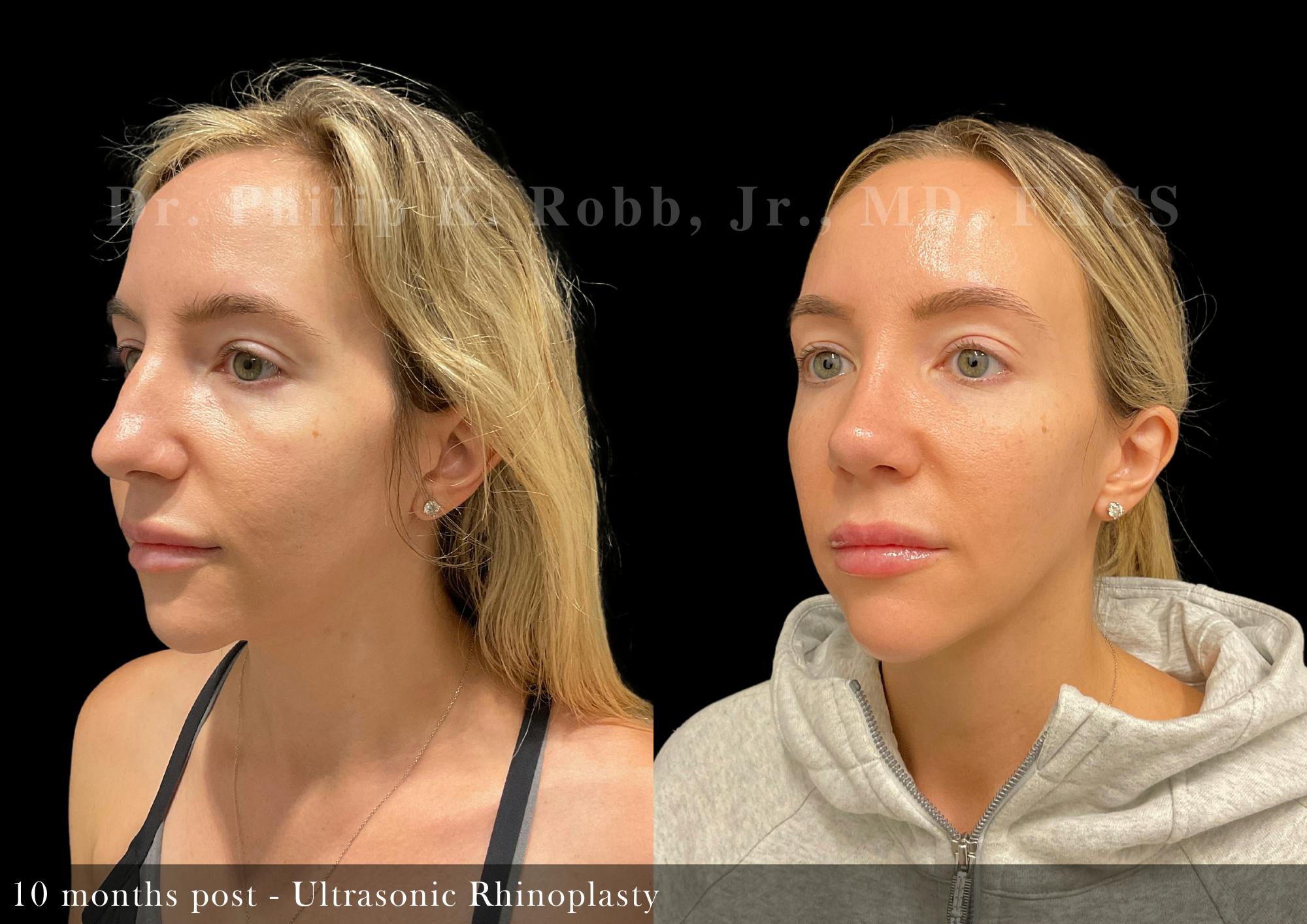 Nose Before & After Gallery - Patient 108882 - Image 5