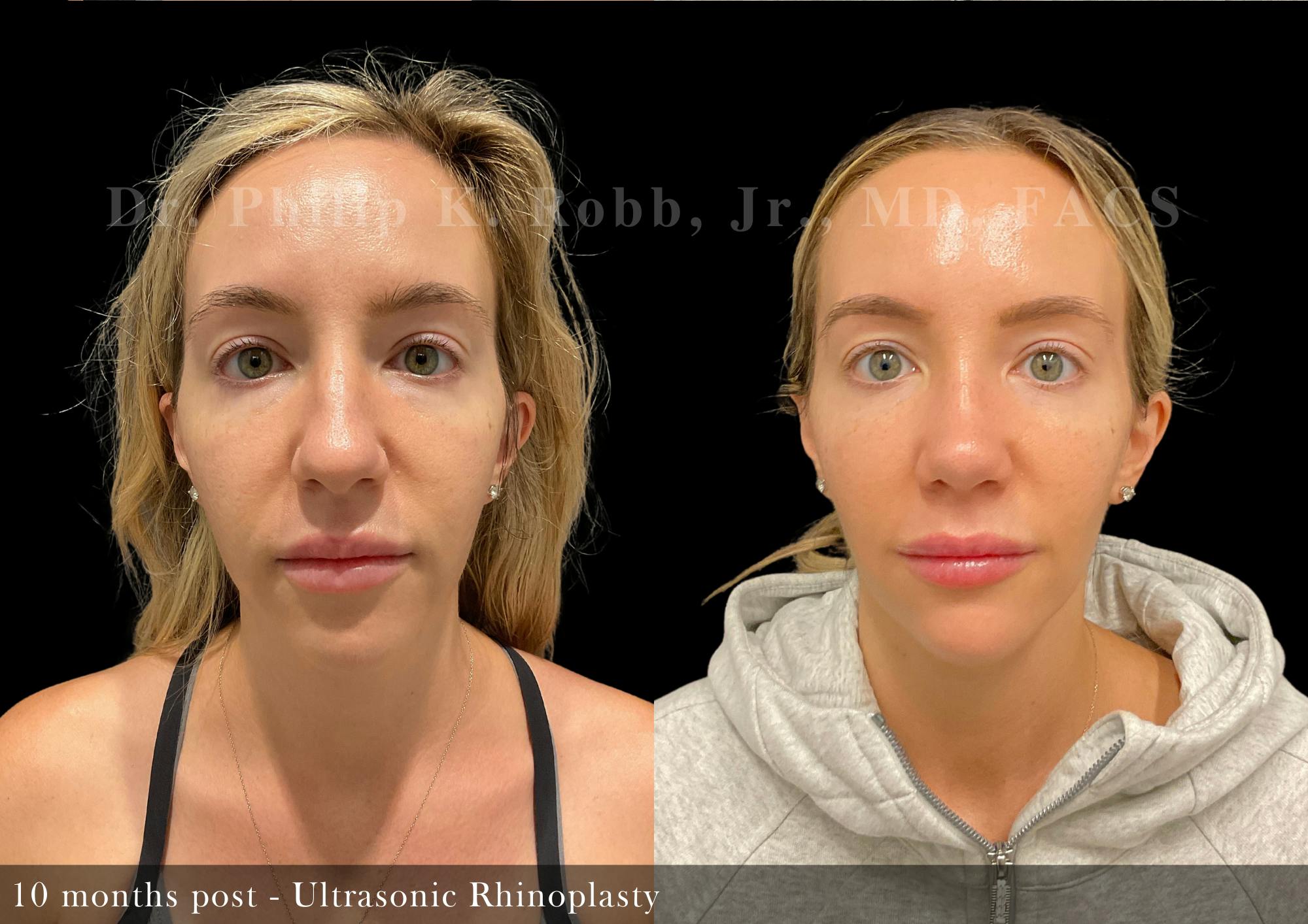 Nose Before & After Gallery - Patient 108882 - Image 3