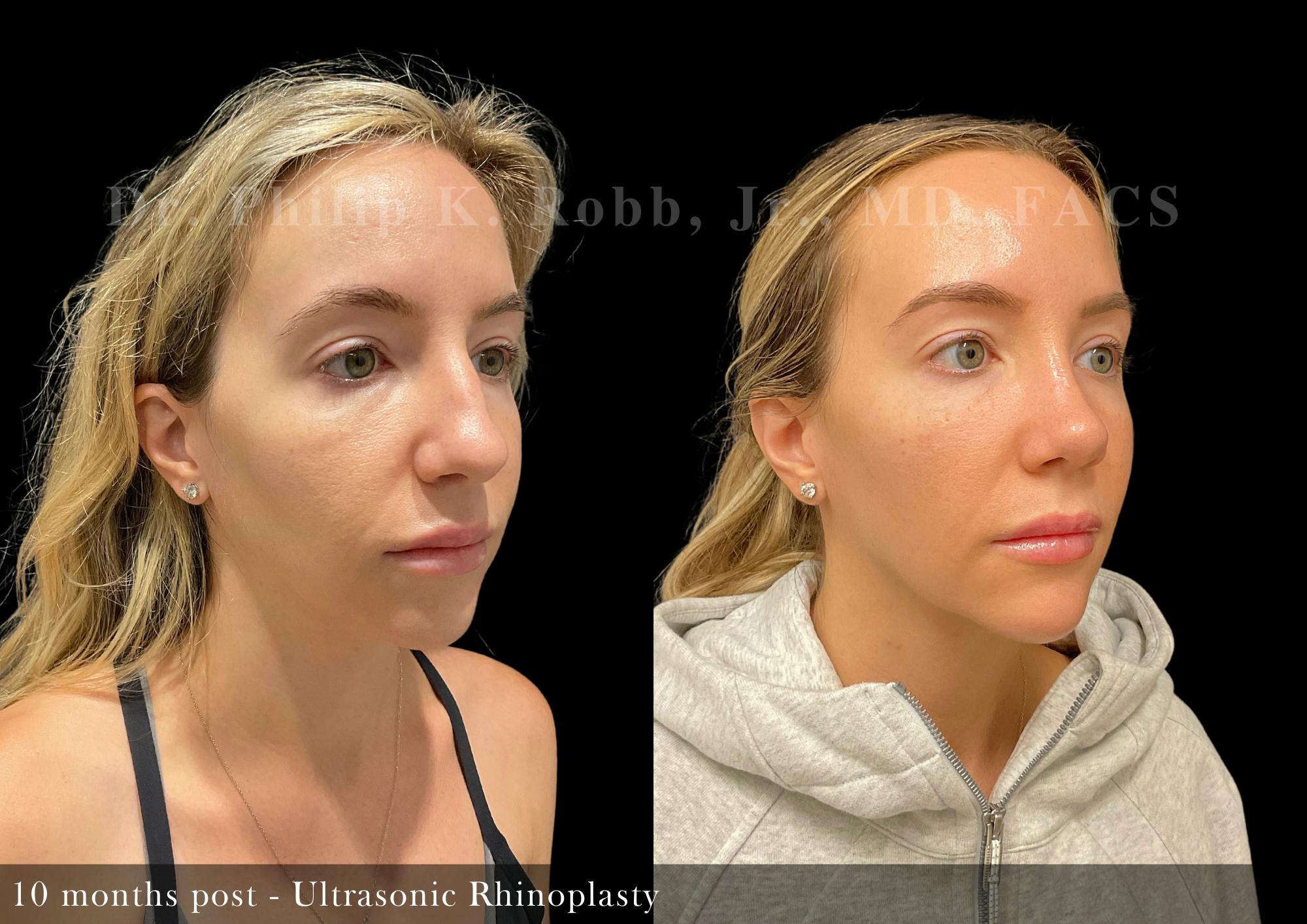 Nose Before & After Gallery - Patient 108882 - Image 2