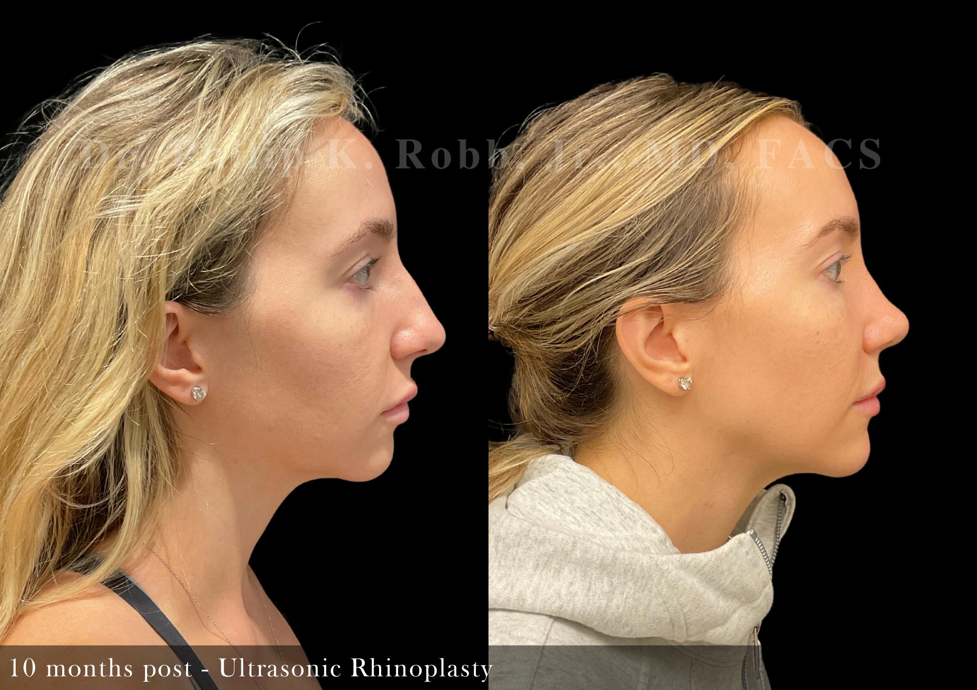 Nose Before & After Gallery - Patient 108882 - Image 1
