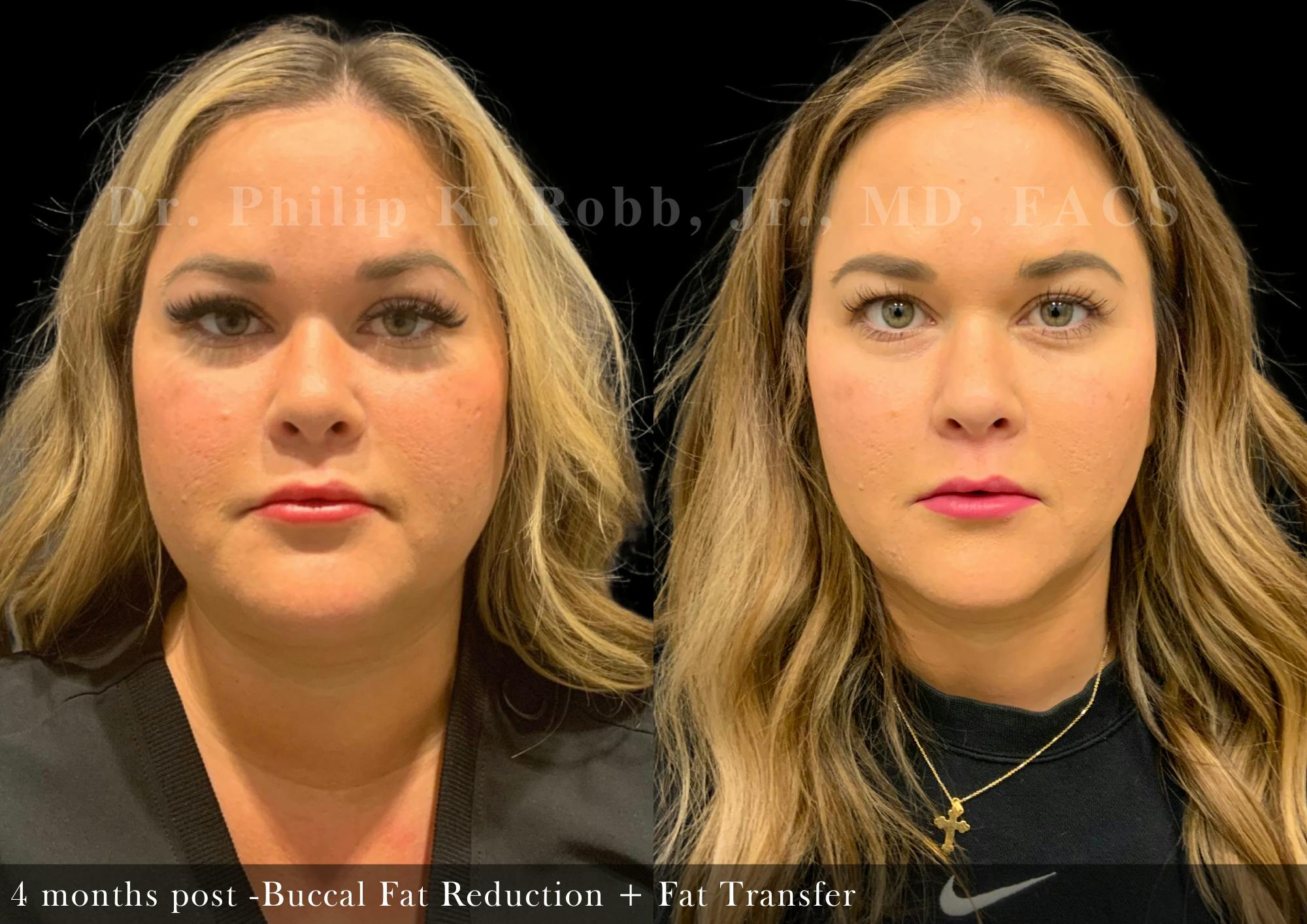 Face Before & After Gallery - Patient 174224 - Image 1