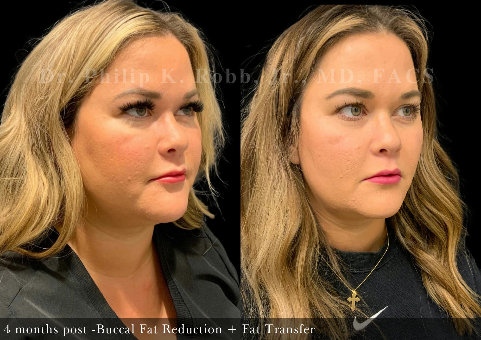 Face Before & After Gallery - Patient 174224 - Image 3