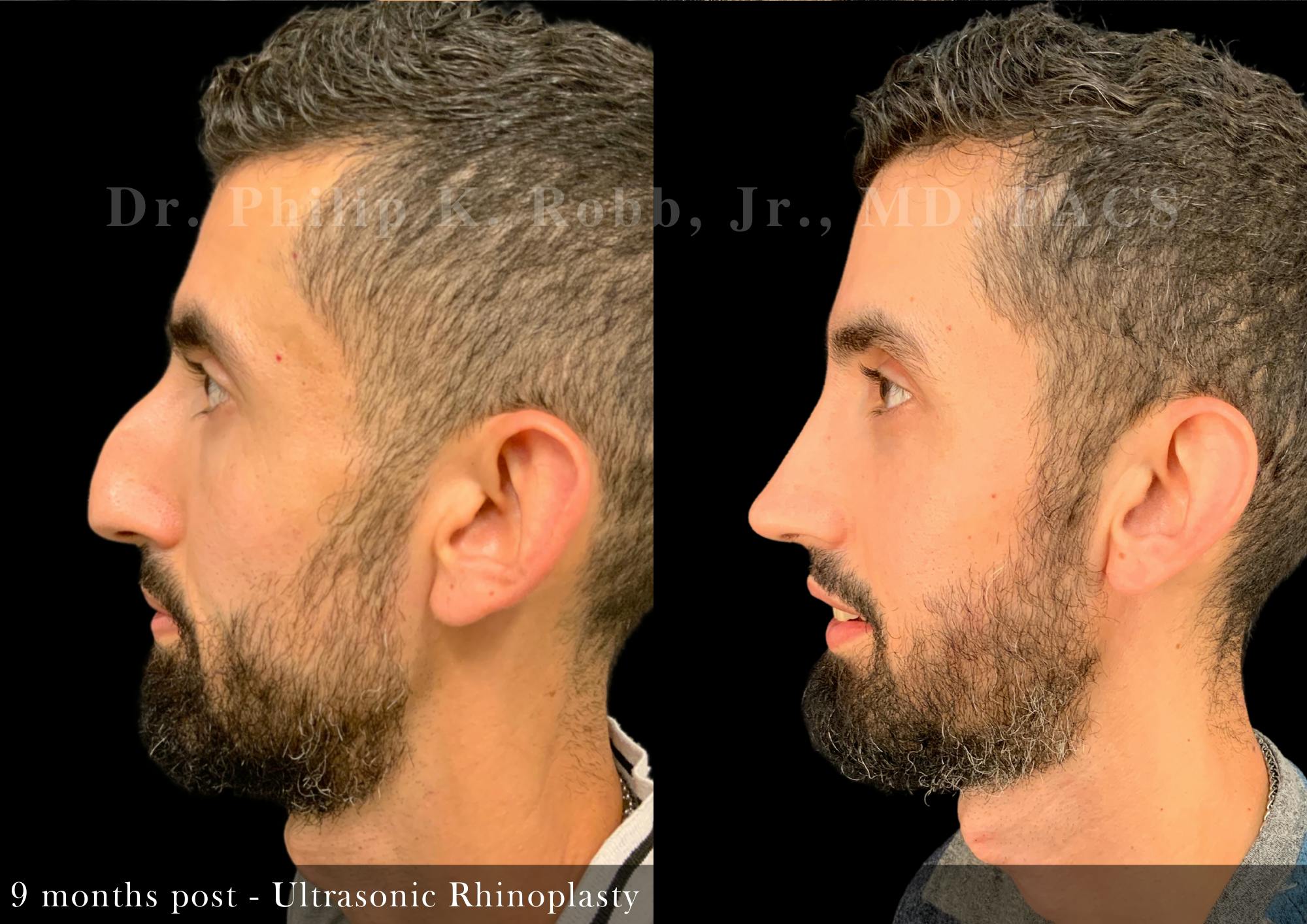 Nose Before & After Gallery - Patient 308879 - Image 4