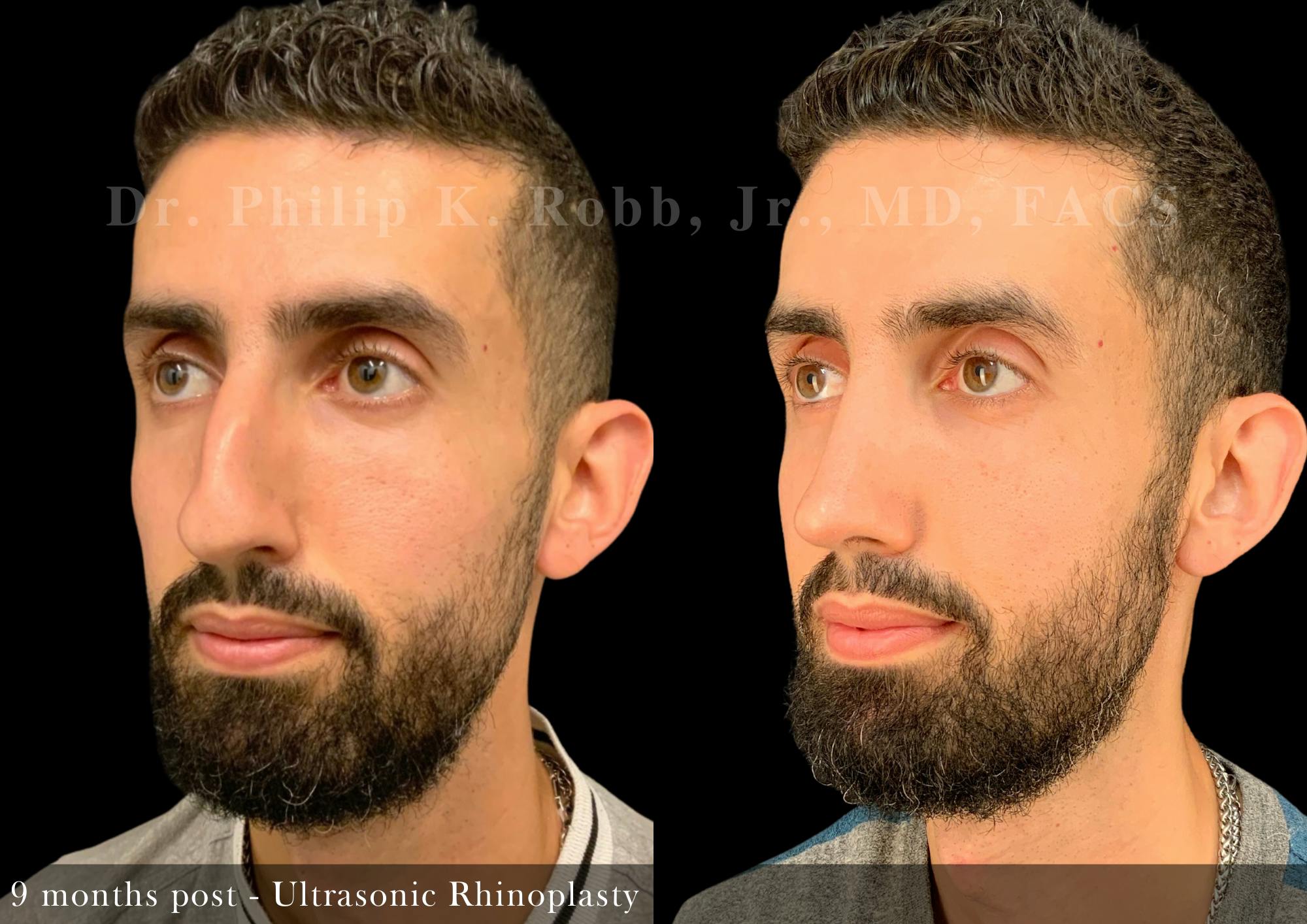 Nose Before & After Gallery - Patient 308879 - Image 5