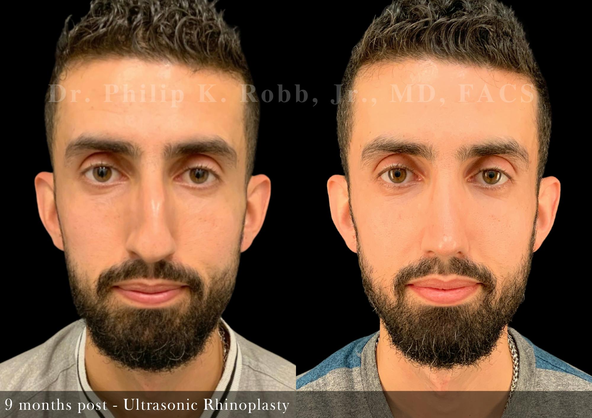 Nose Before & After Gallery - Patient 308879 - Image 3