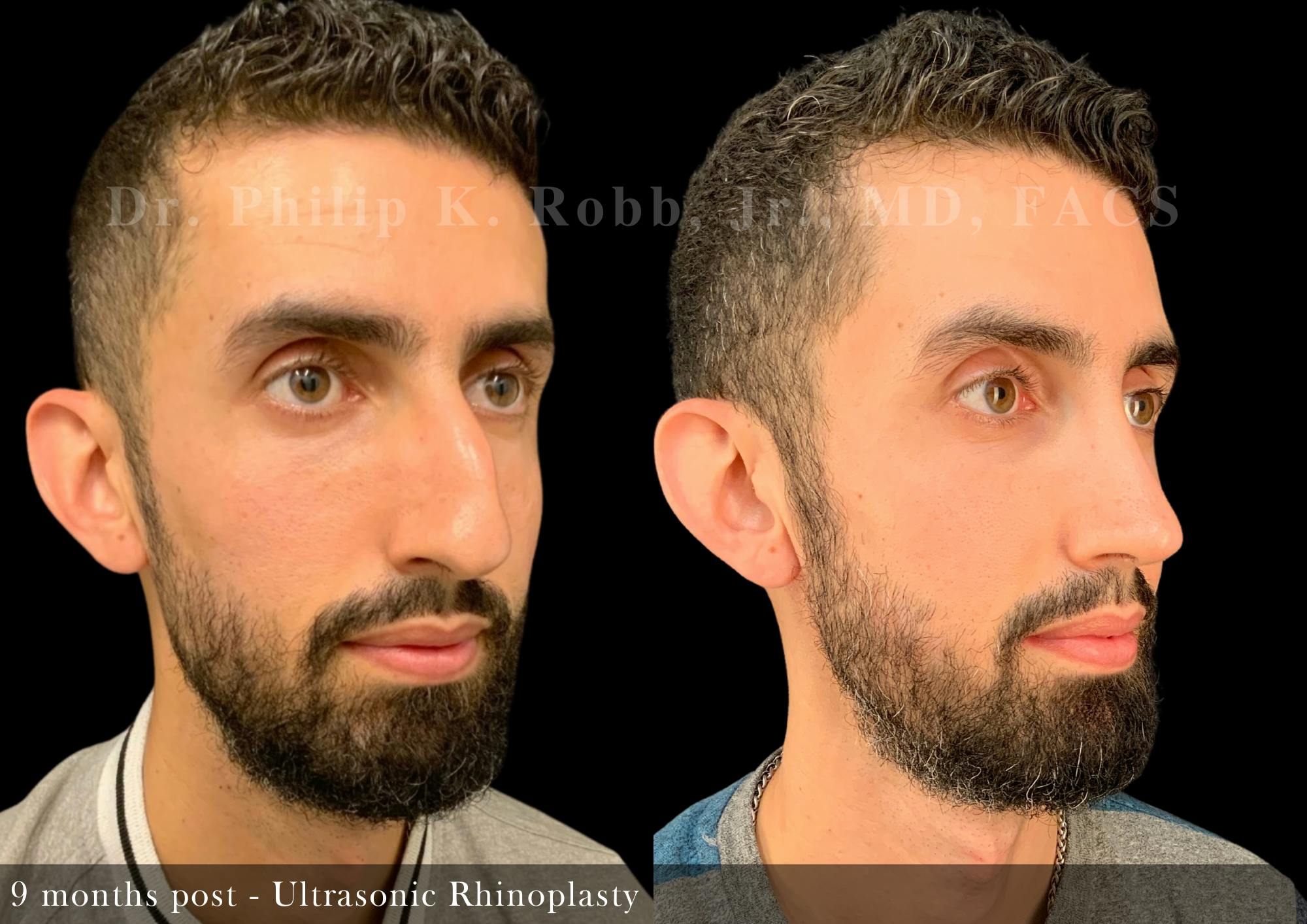 Nose Before & After Gallery - Patient 308879 - Image 2