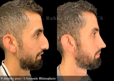 Nose Before & After Gallery - Patient 308879 - Image 1