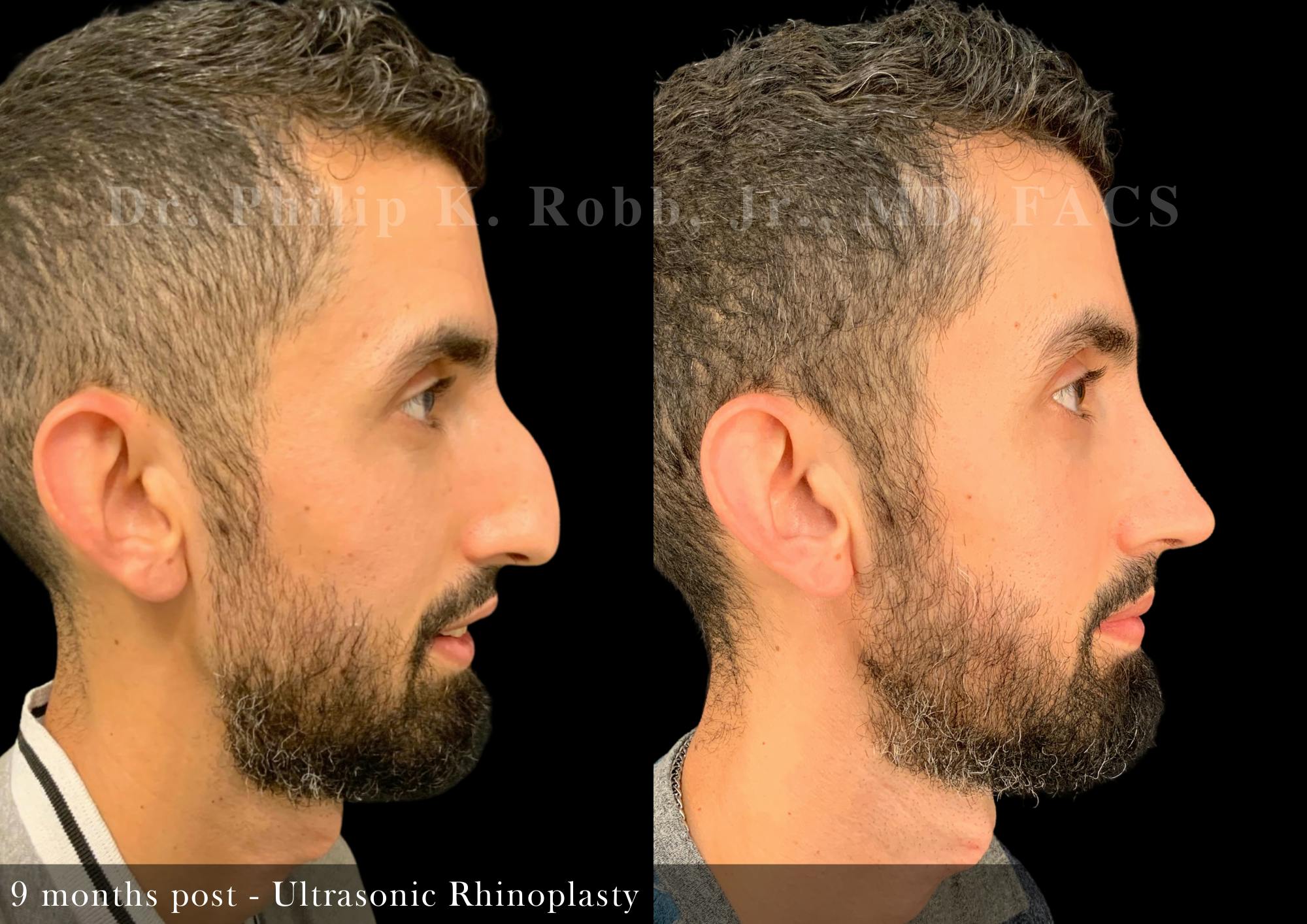 Nose Before & After Gallery - Patient 308879 - Image 1
