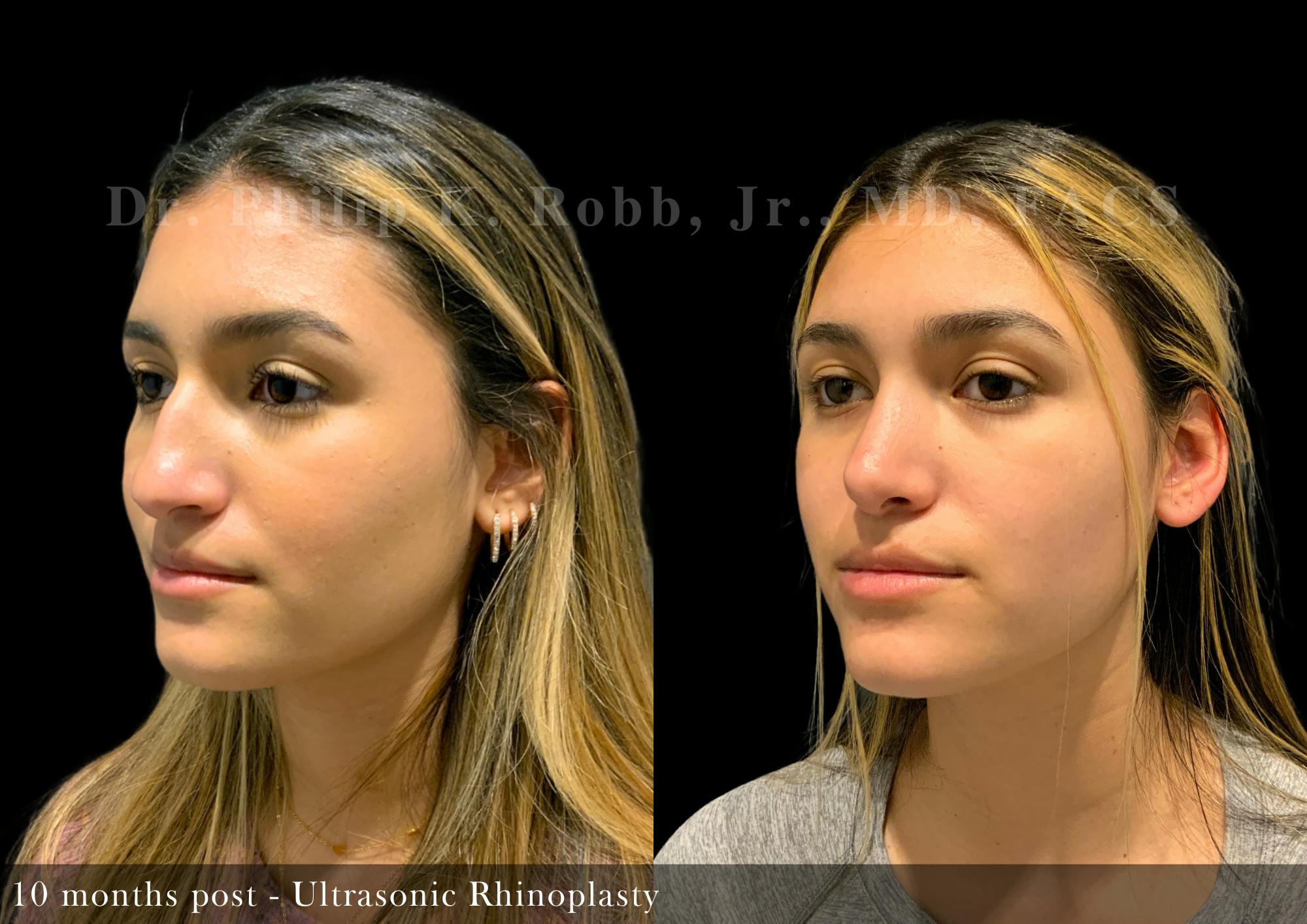 Nose Before & After Gallery - Patient 138433 - Image 4