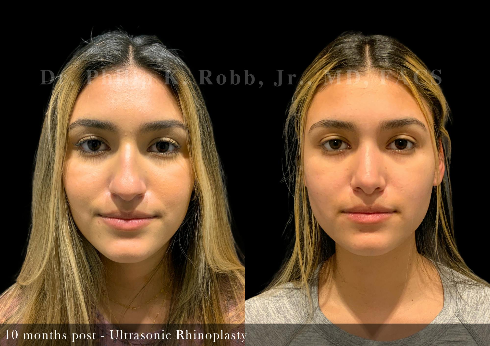 Nose Before & After Gallery - Patient 138433 - Image 3