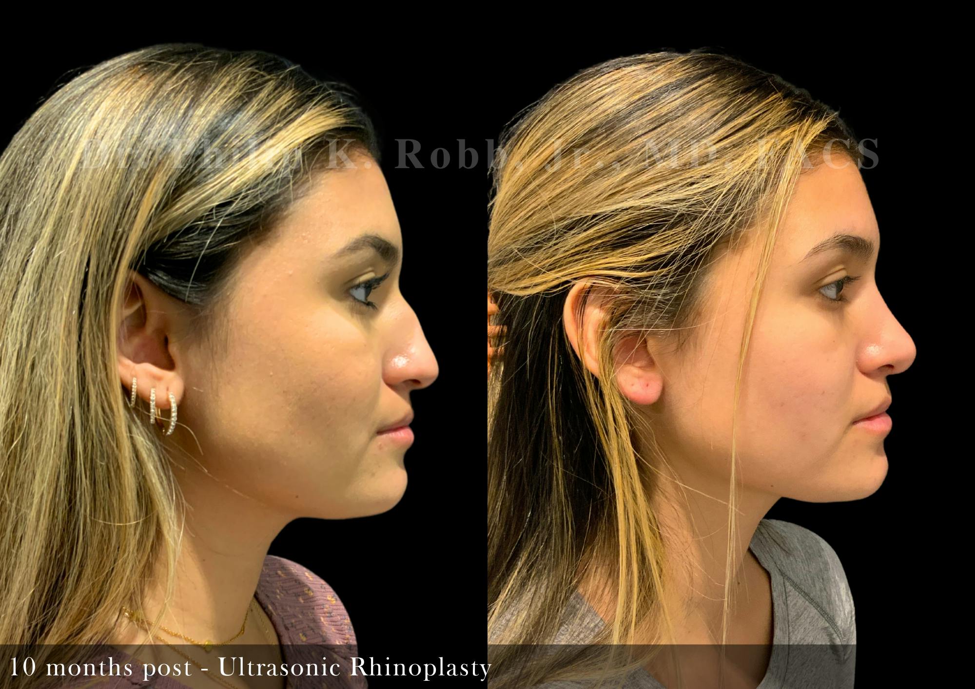 Nose Before & After Gallery - Patient 138433 - Image 1
