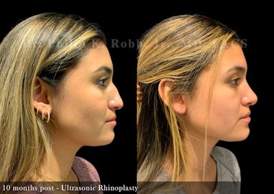 Nose Before & After Gallery - Patient 138433 - Image 1