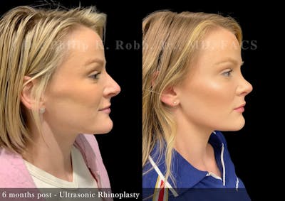 Nose Before & After Gallery - Patient 297379 - Image 1