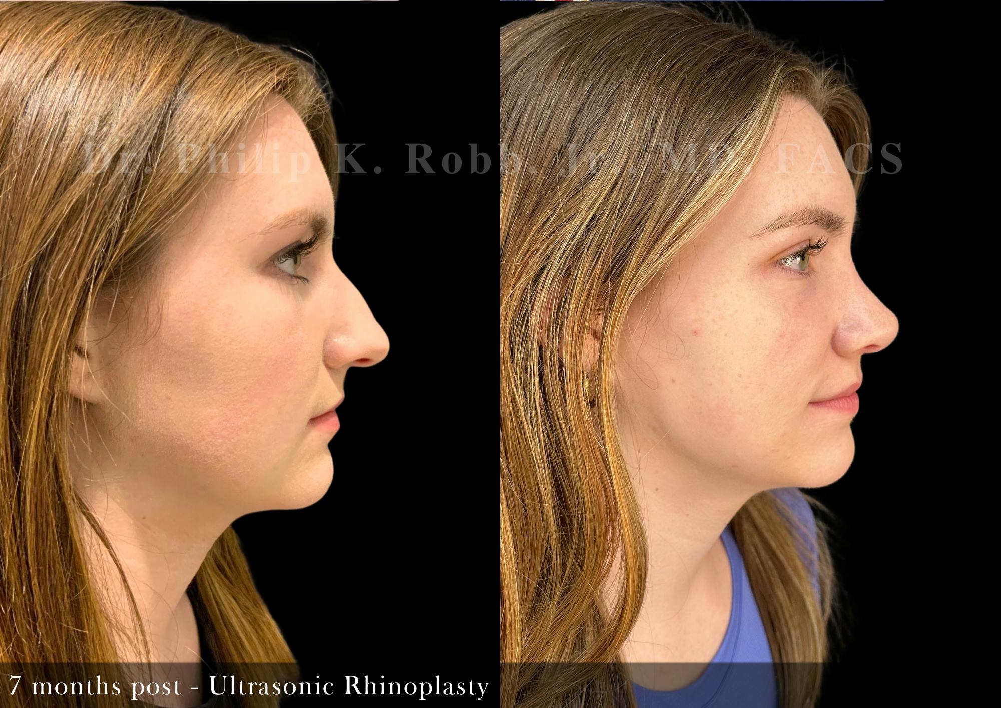 Nose Before & After Gallery - Patient 169182 - Image 1