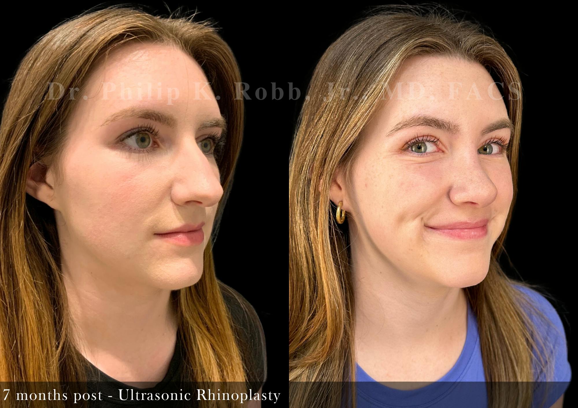 Nose Before & After Gallery - Patient 169182 - Image 2