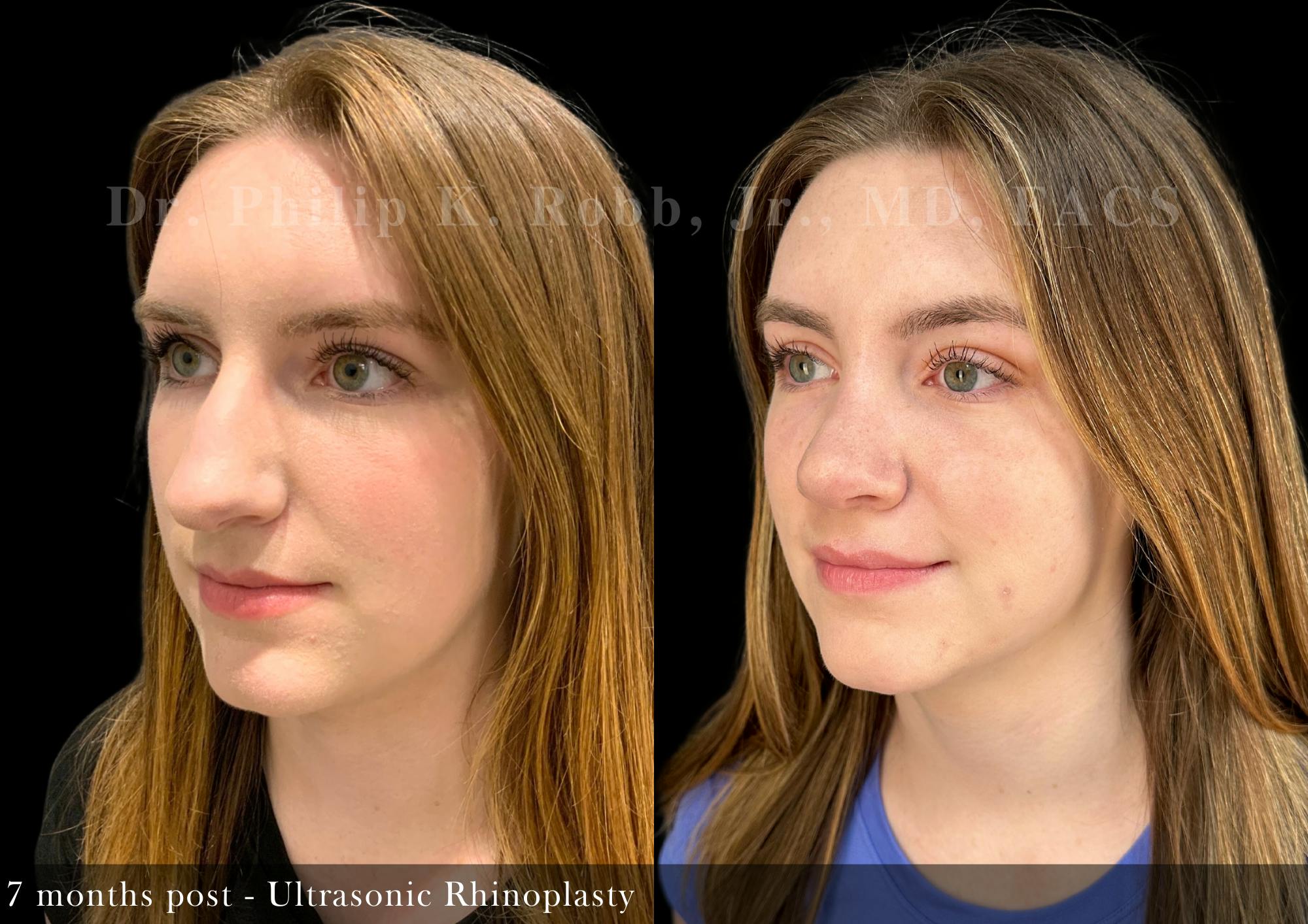 Nose Before & After Gallery - Patient 169182 - Image 4
