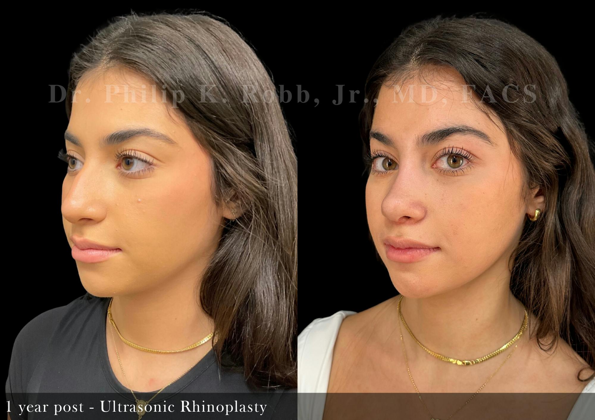 Nose Before & After Gallery - Patient 367397 - Image 4