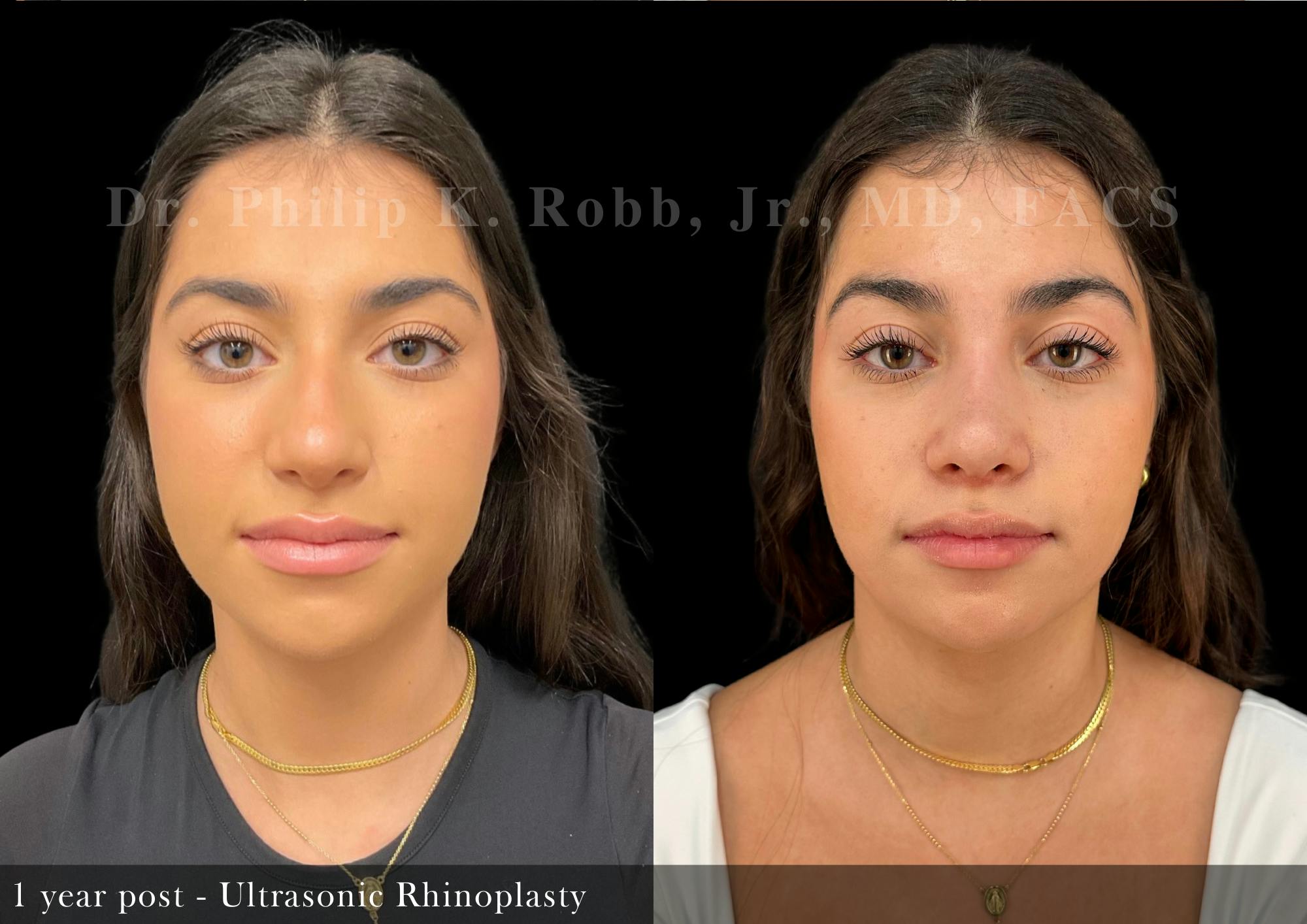 Nose Before & After Gallery - Patient 367397 - Image 3