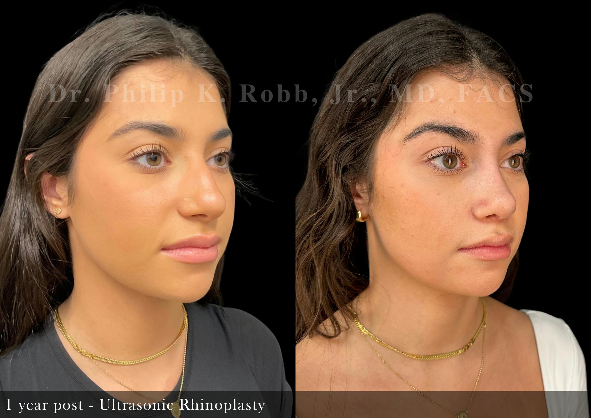Nose Before & After Gallery - Patient 367397 - Image 2