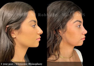 Nose Before & After Gallery - Patient 367397 - Image 1