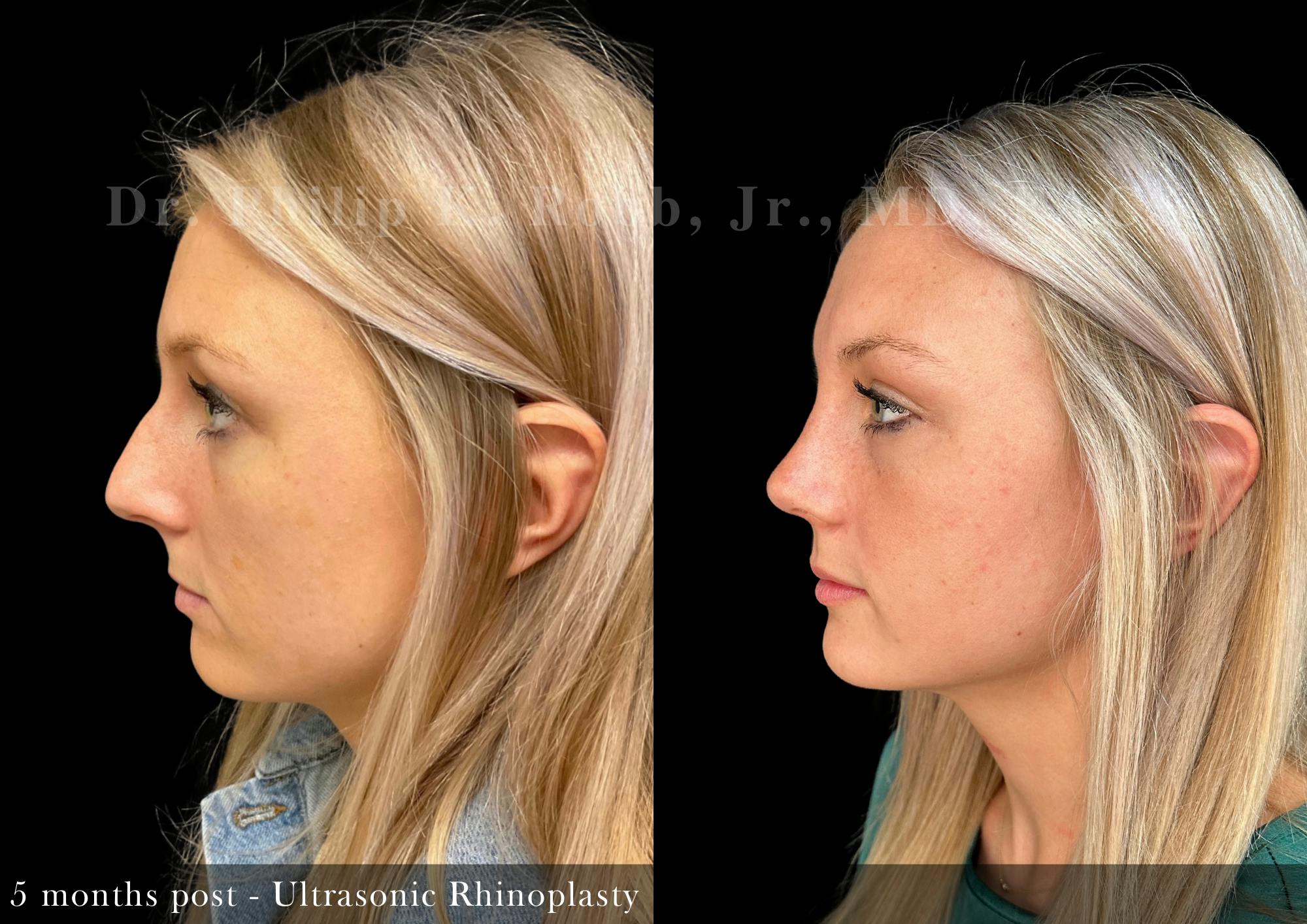 Nose Before & After Gallery - Patient 329102 - Image 5
