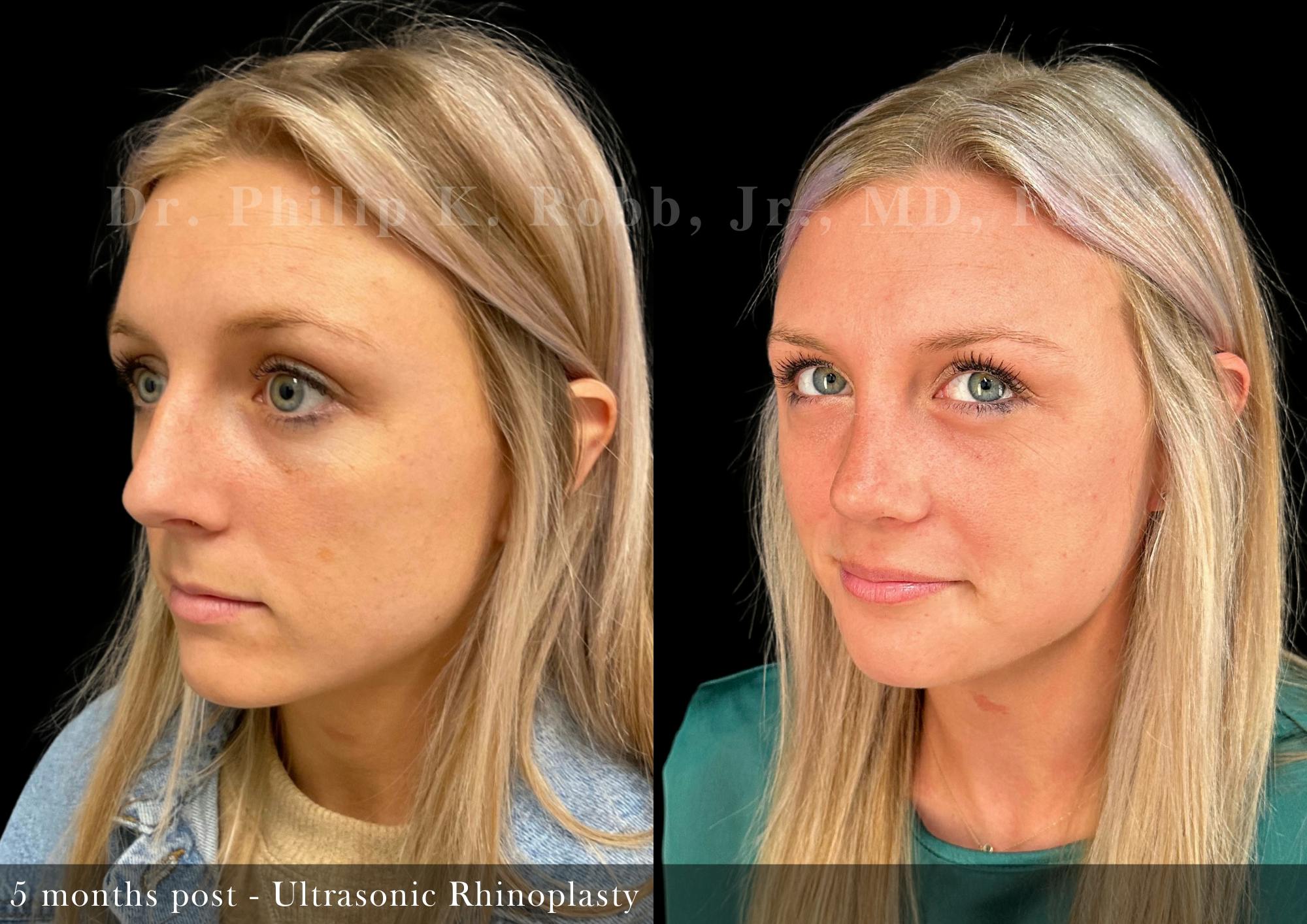 Nose Before & After Gallery - Patient 329102 - Image 4