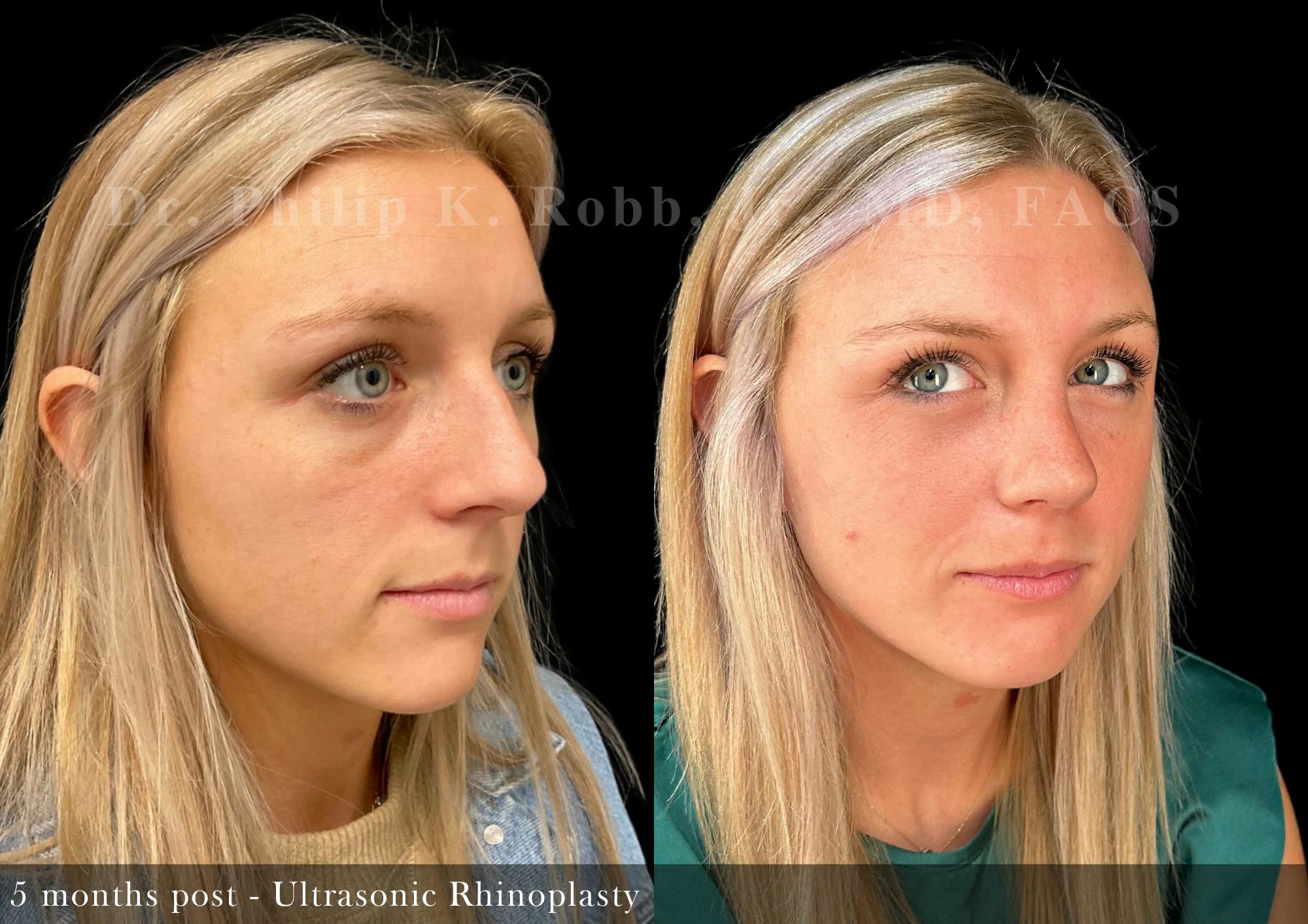 Nose Before & After Gallery - Patient 329102 - Image 2