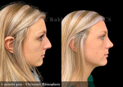 Nose Before & After Gallery - Patient 329102 - Image 1