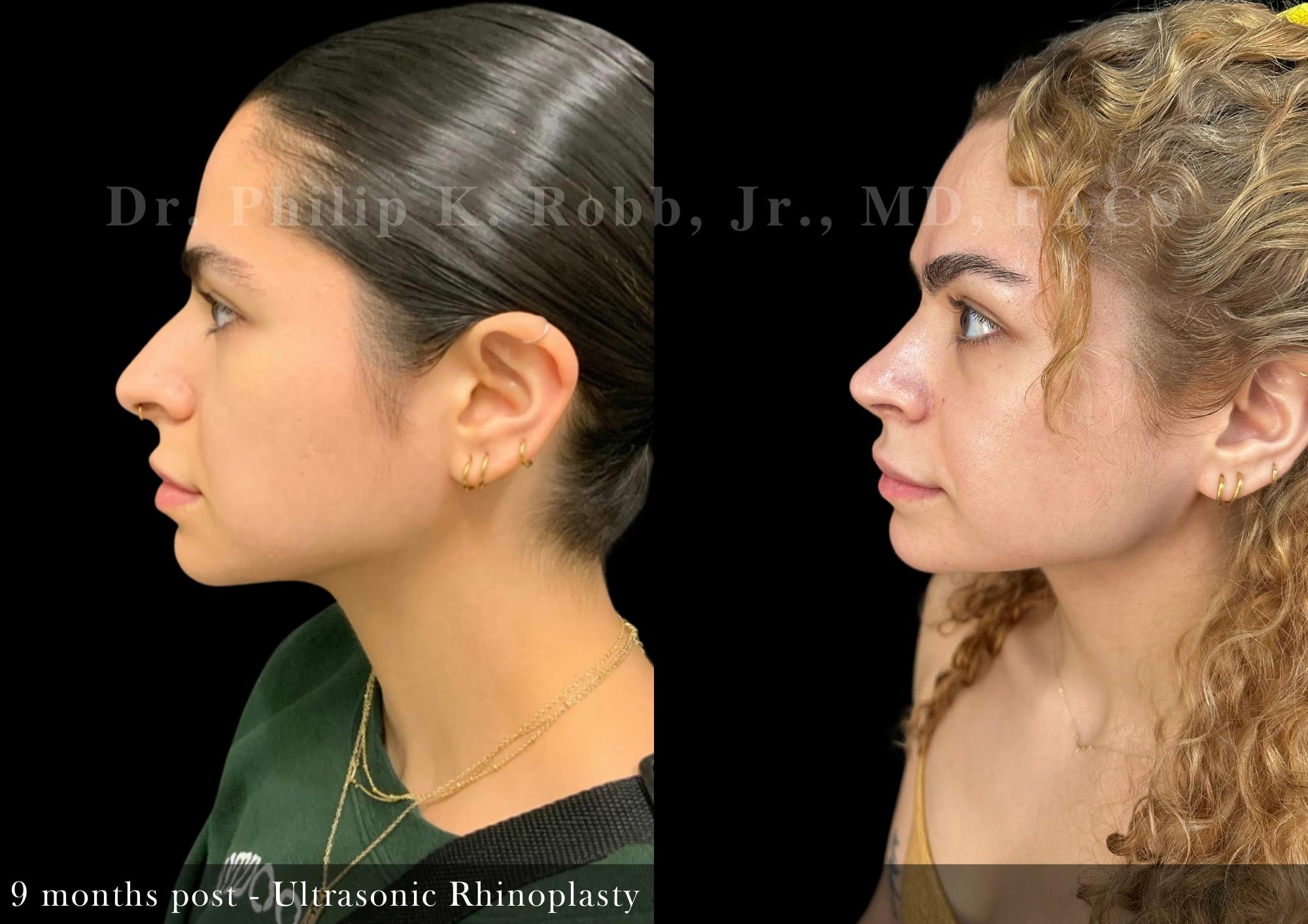 Nose Before & After Gallery - Patient 156096 - Image 5