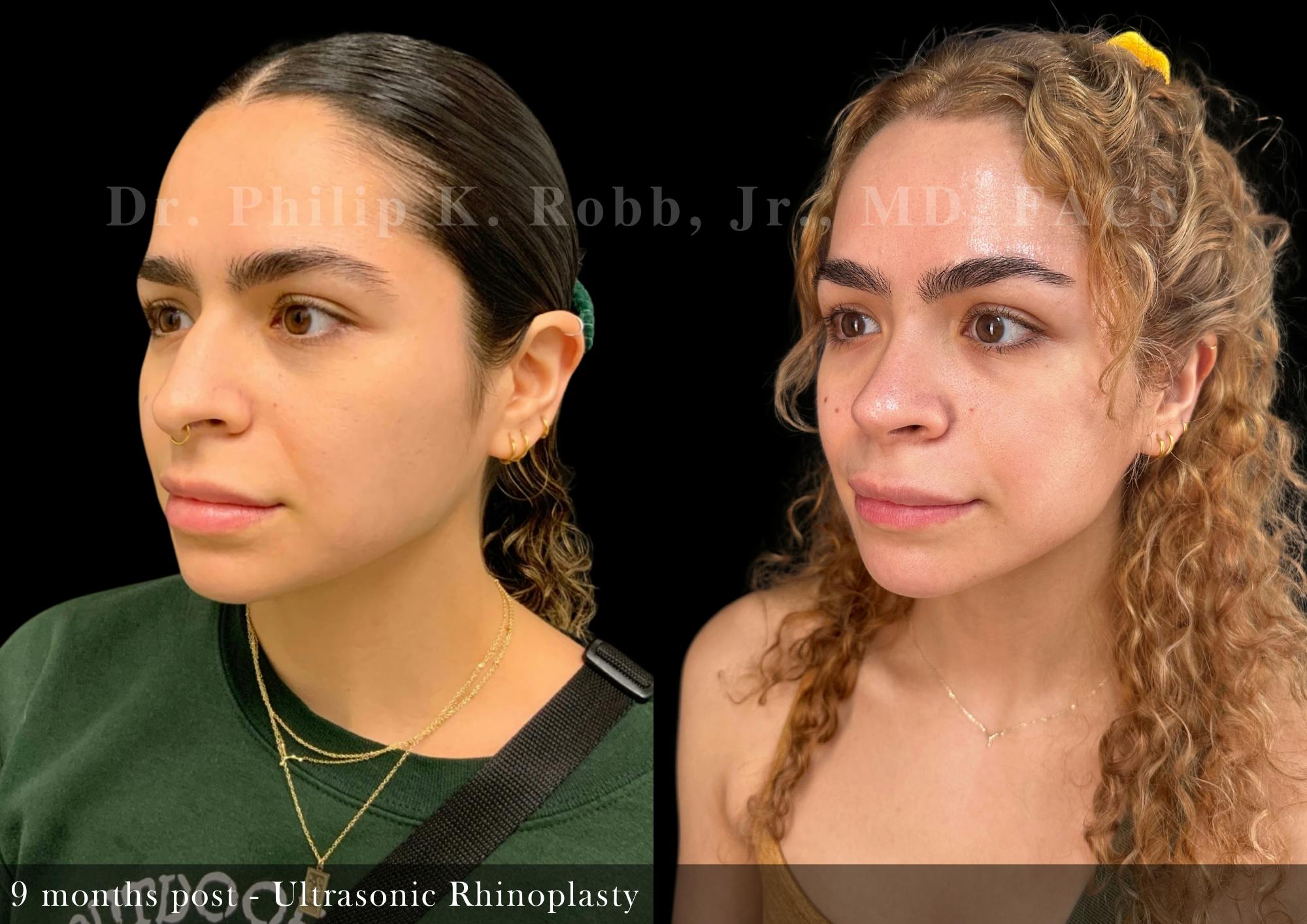 Nose Before & After Gallery - Patient 156096 - Image 4
