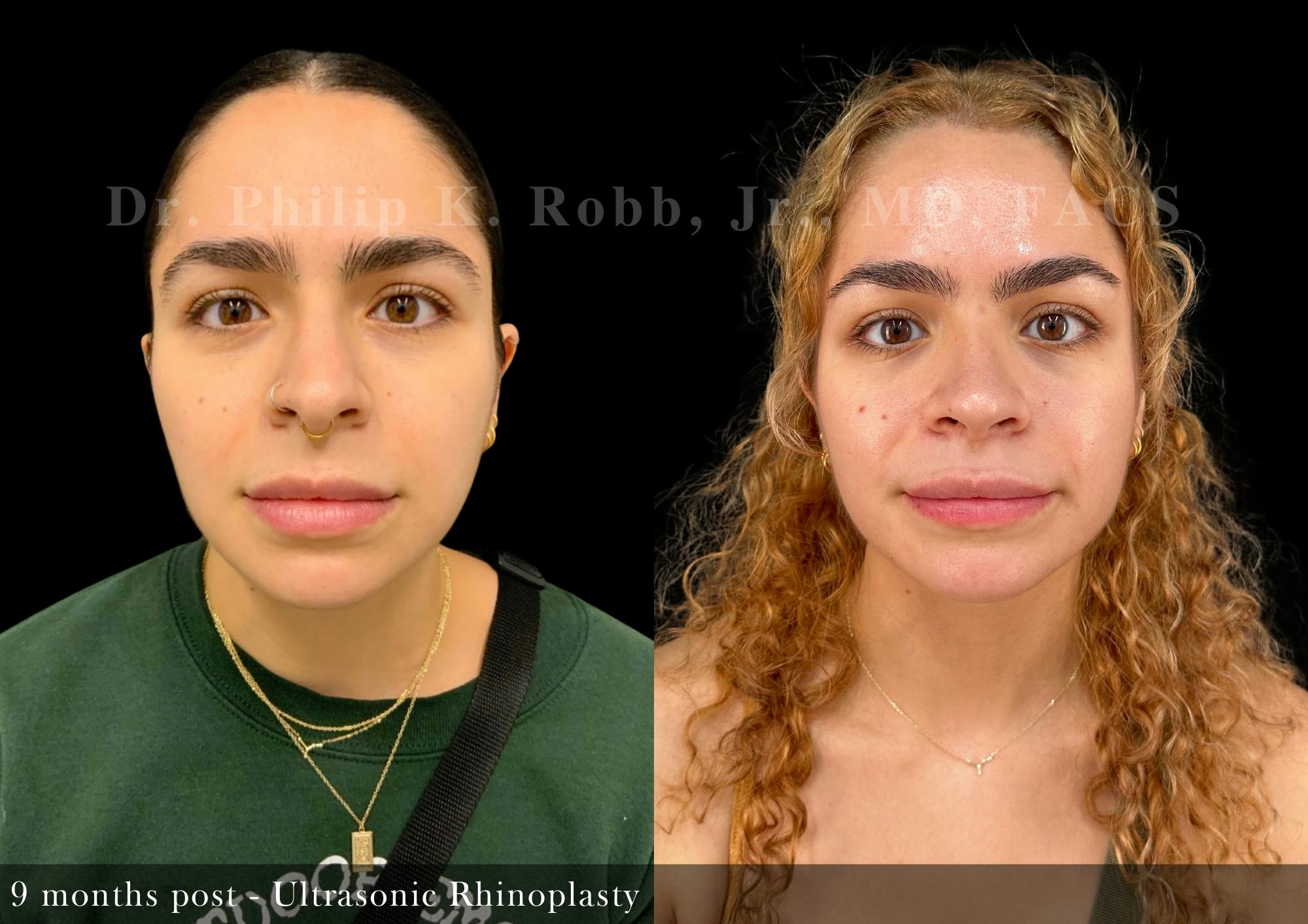 Nose Before & After Gallery - Patient 156096 - Image 3