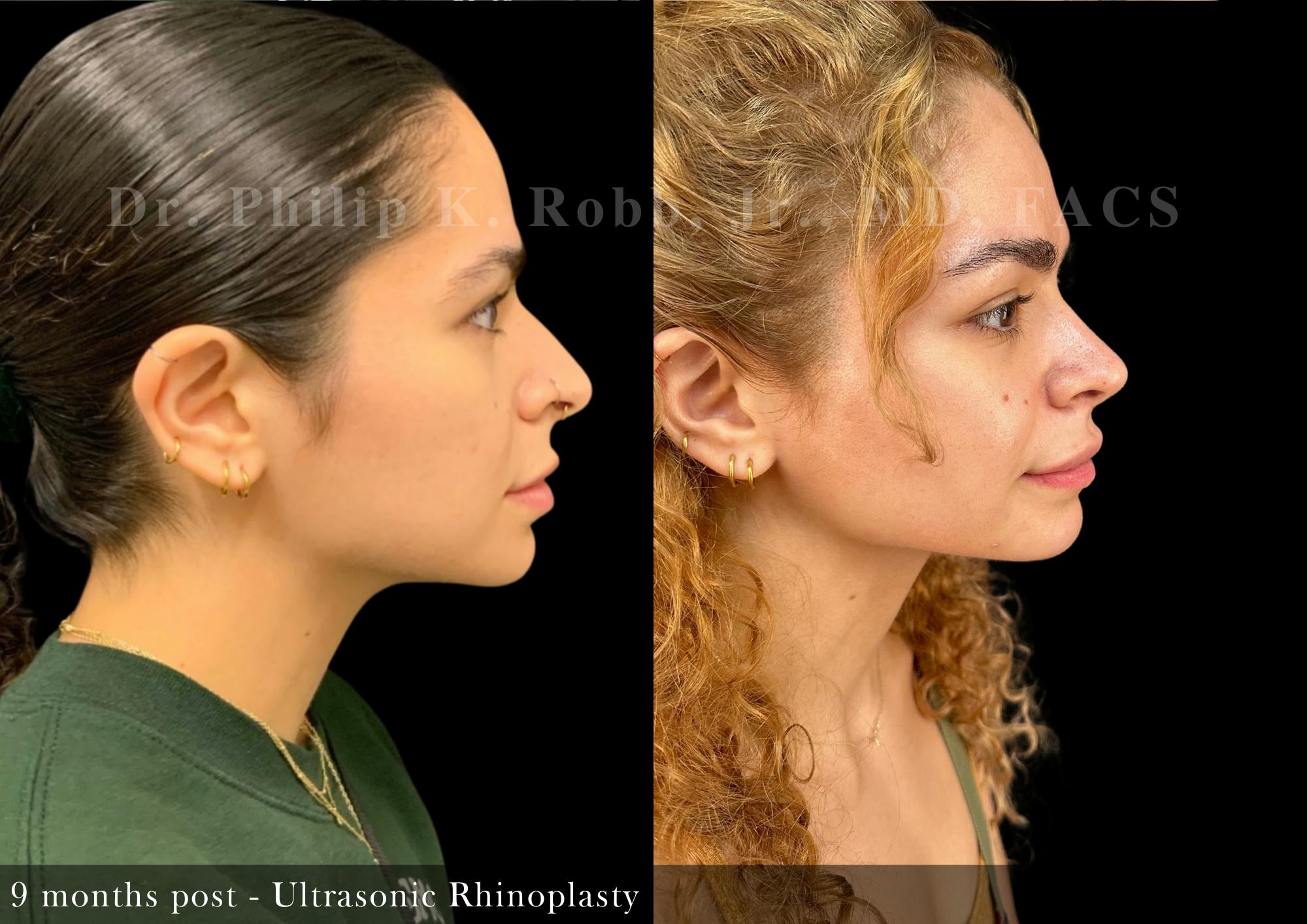 Nose Before & After Gallery - Patient 156096 - Image 1