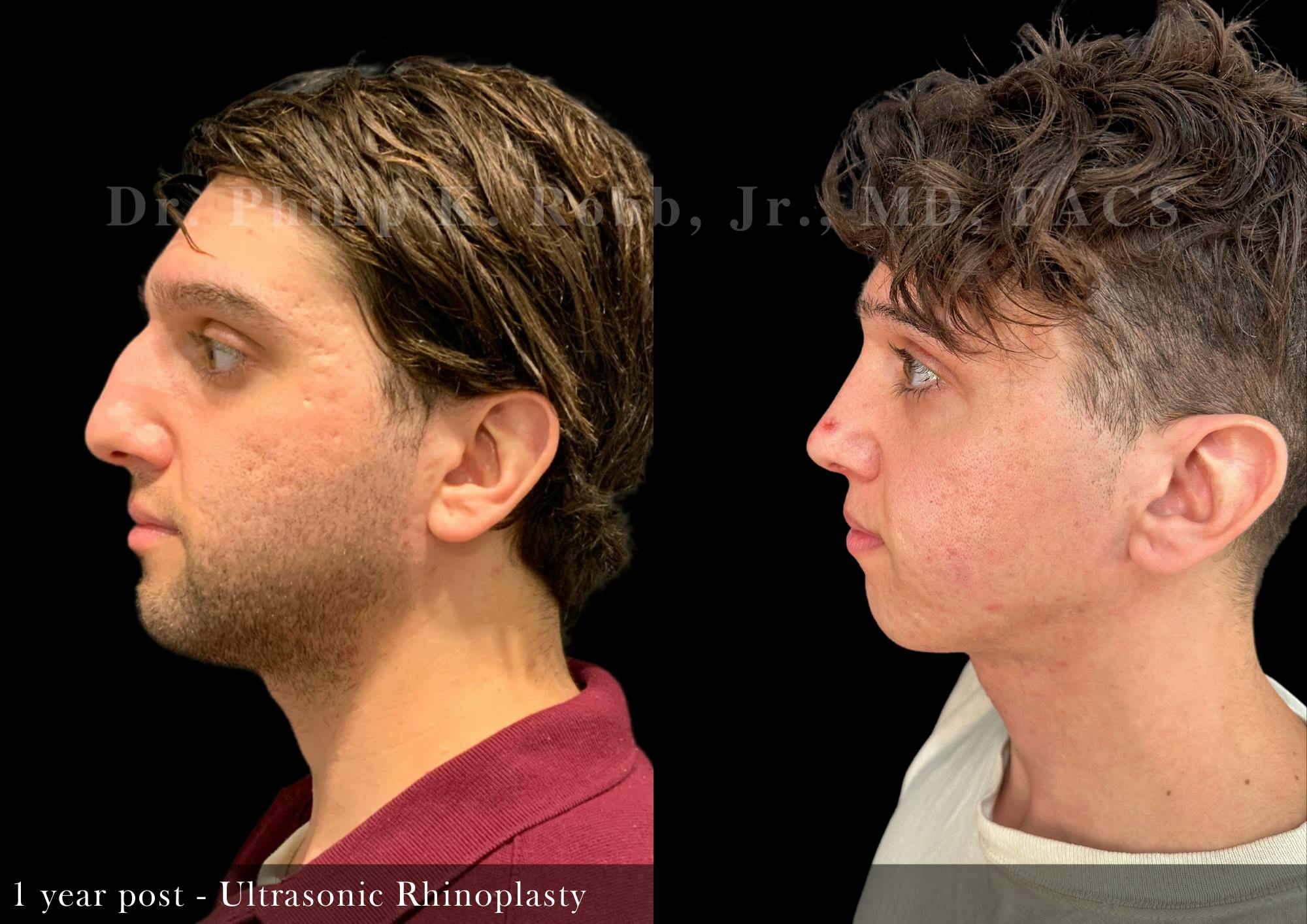 Nose Before & After Gallery - Patient 243832 - Image 5