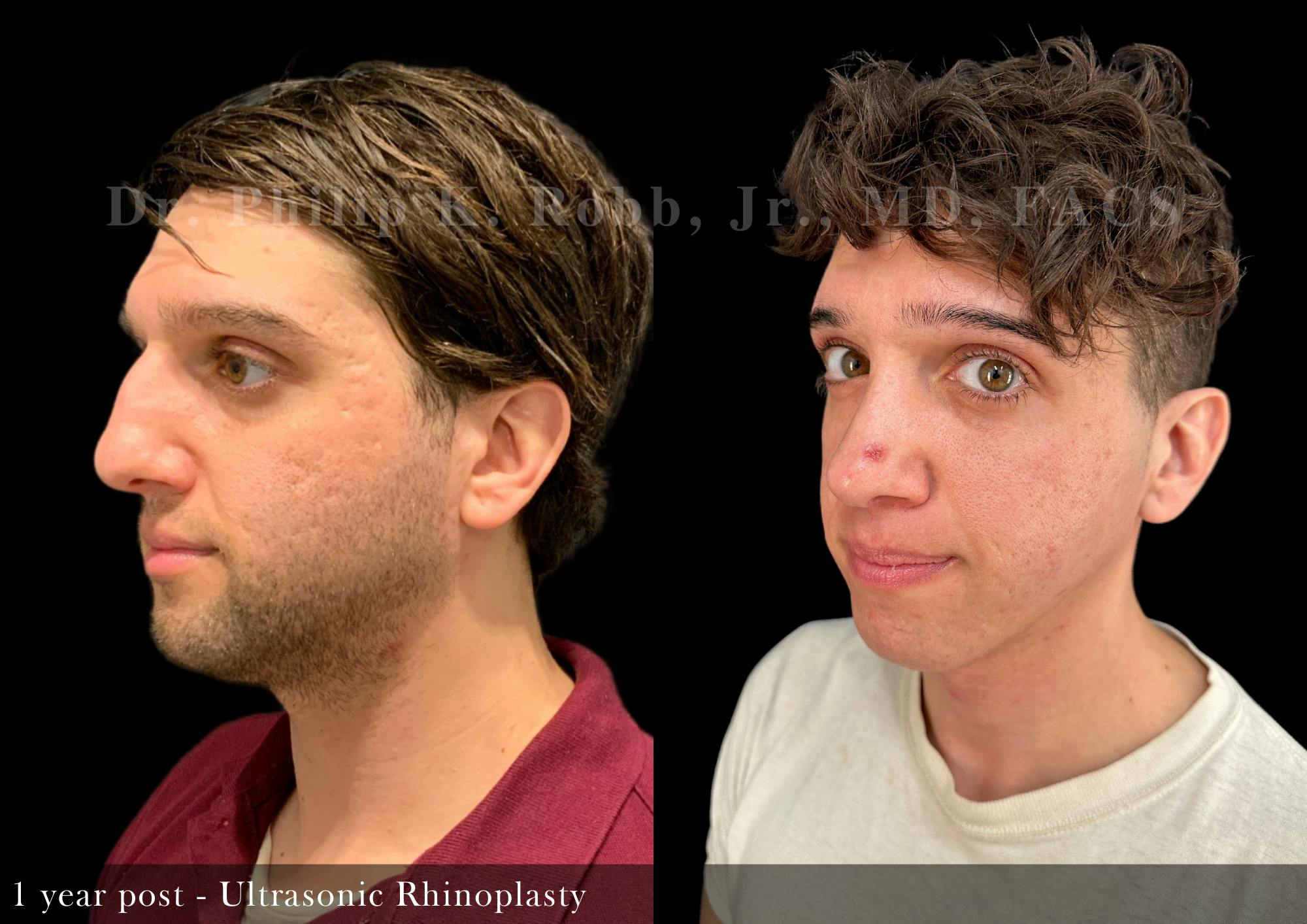 Nose Before & After Gallery - Patient 243832 - Image 4
