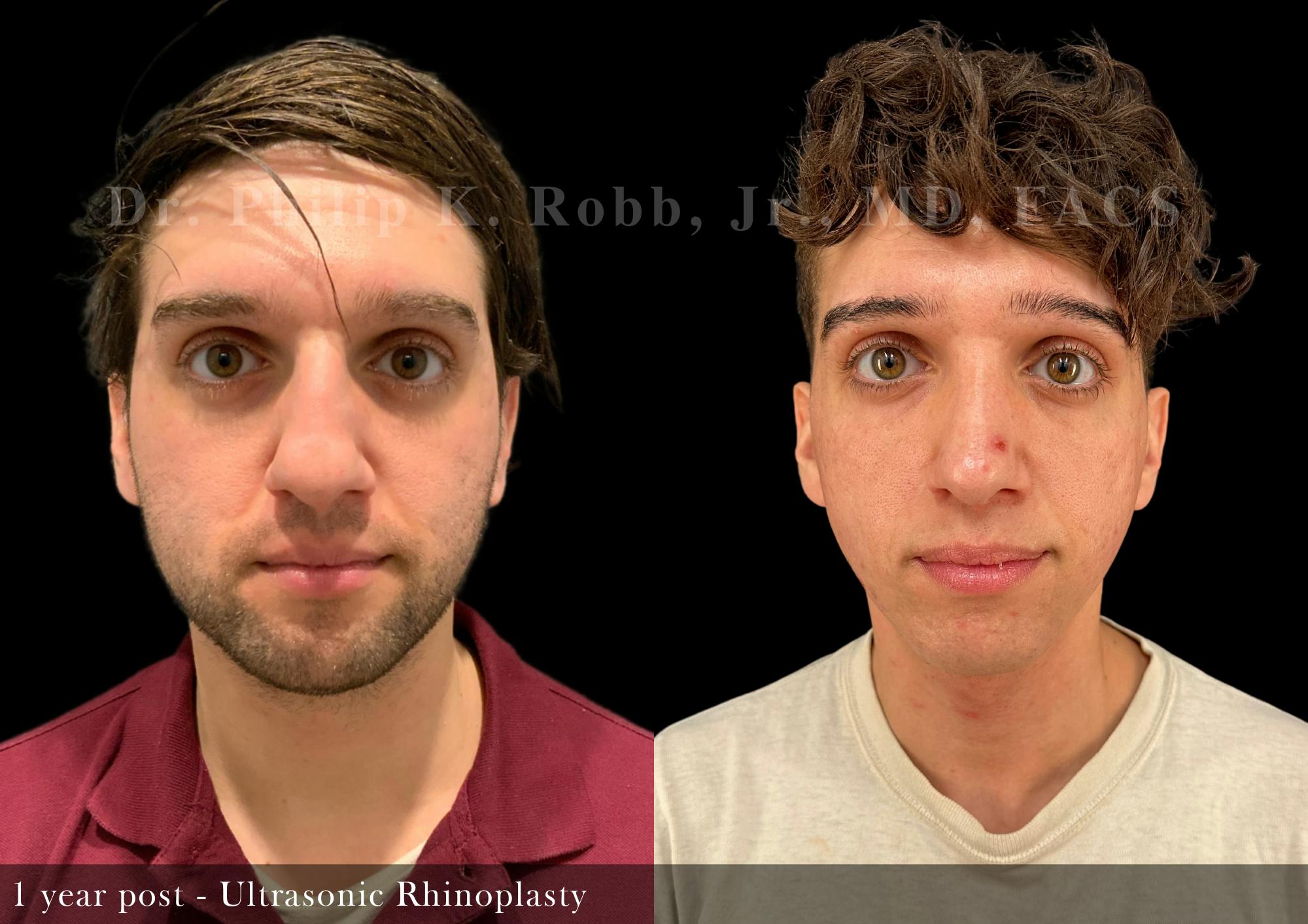Nose Before & After Gallery - Patient 243832 - Image 3
