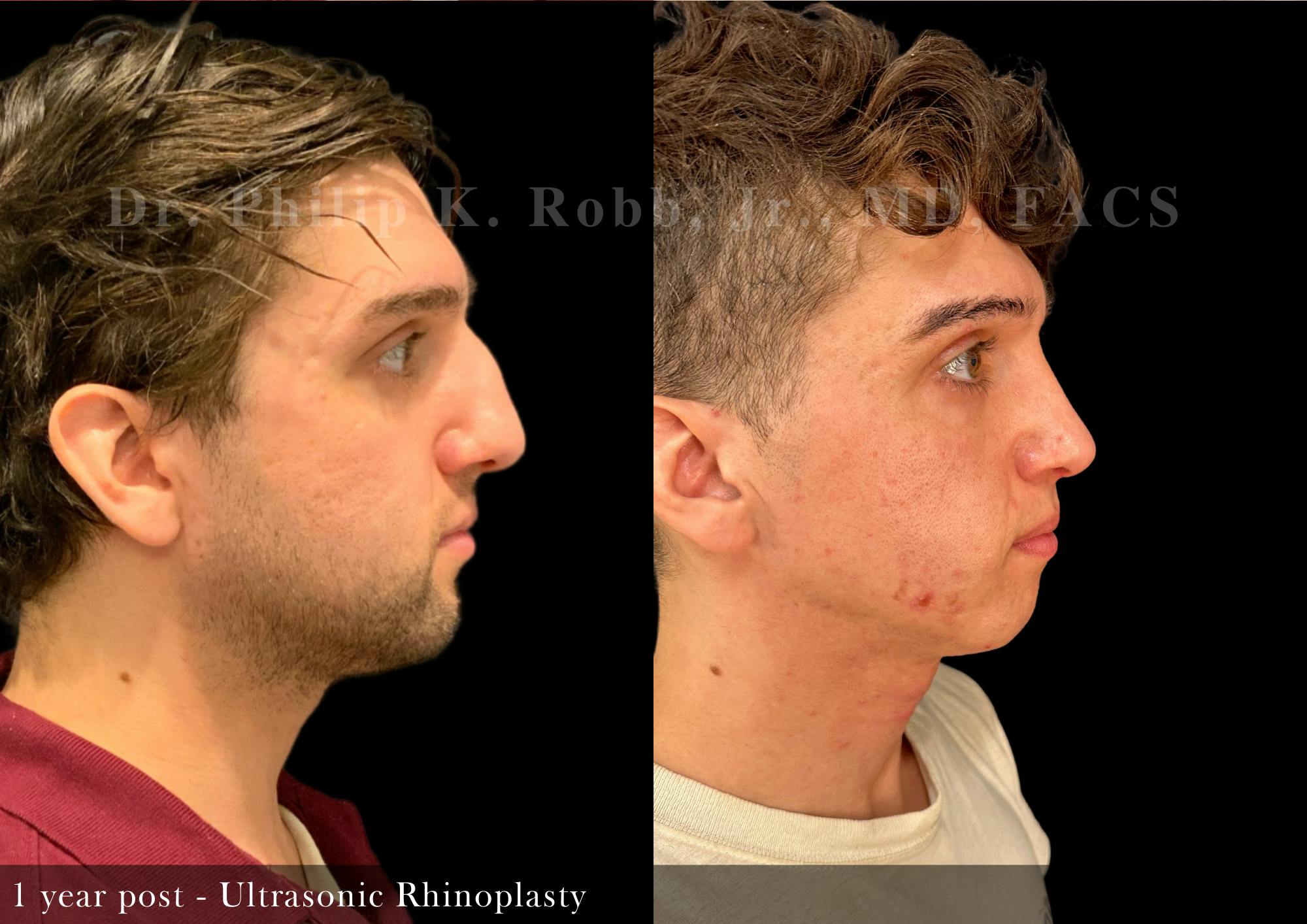Nose Before & After Gallery - Patient 243832 - Image 1
