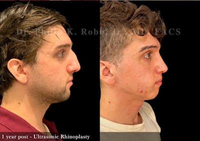 Nose Before & After Gallery - Patient 243832 - Image 1