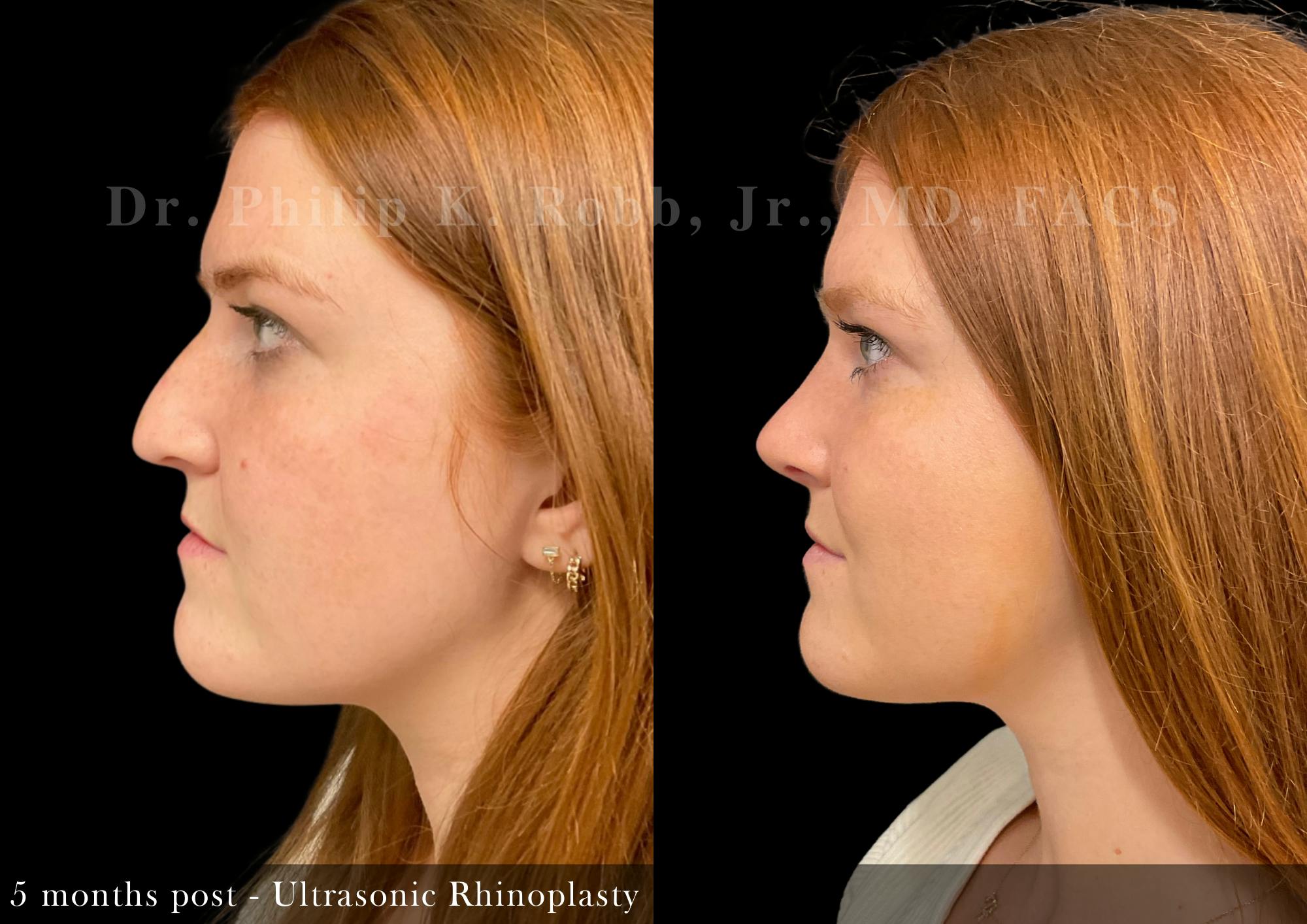 Nose Before & After Gallery - Patient 357991 - Image 5