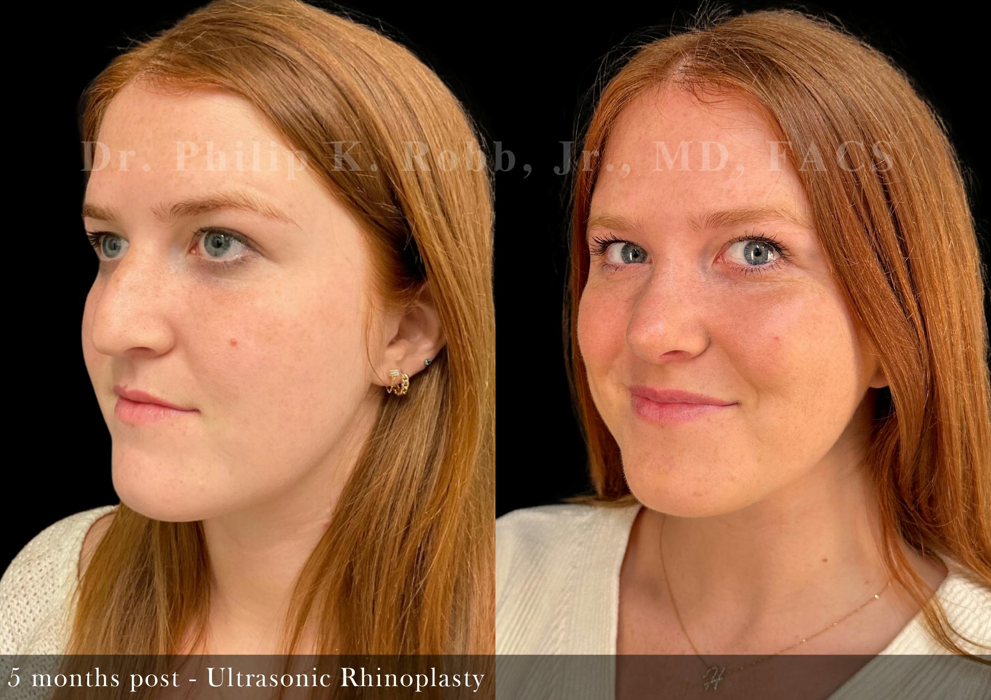 Nose Before & After Gallery - Patient 357991 - Image 4