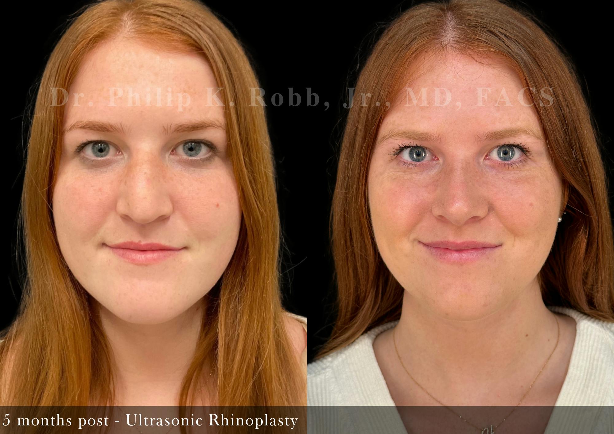 Nose Before & After Gallery - Patient 357991 - Image 3