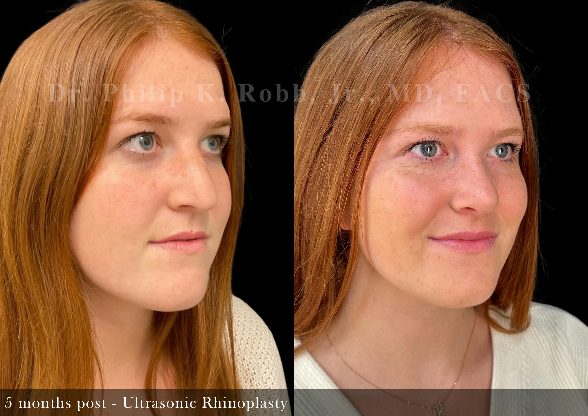 Nose Before & After Gallery - Patient 357991 - Image 2