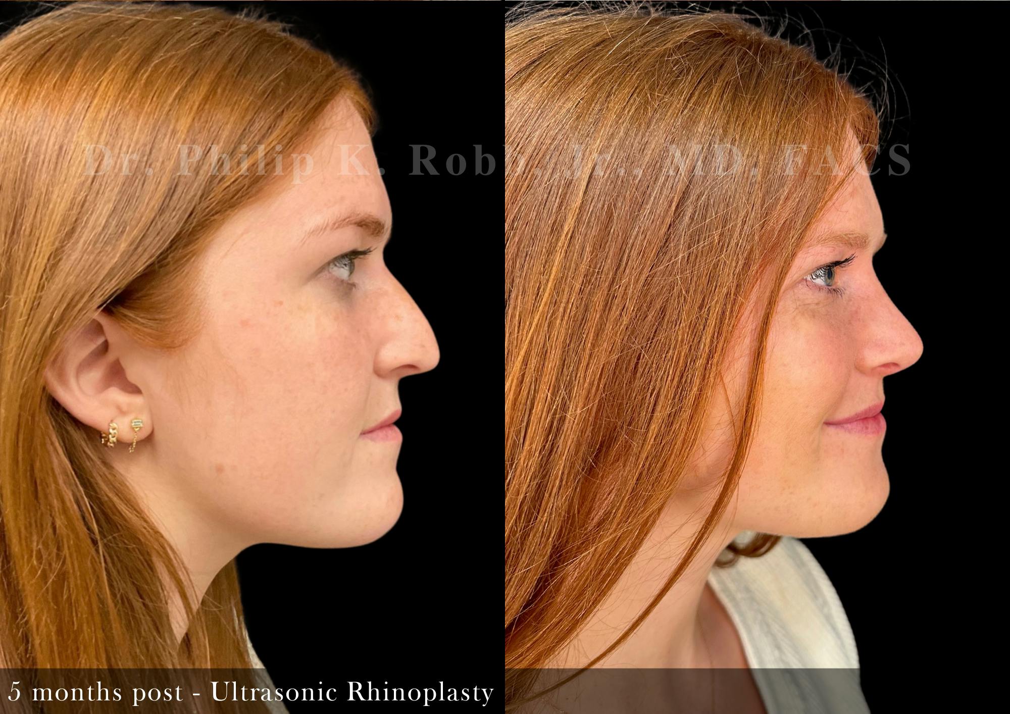 Nose Before & After Gallery - Patient 357991 - Image 1