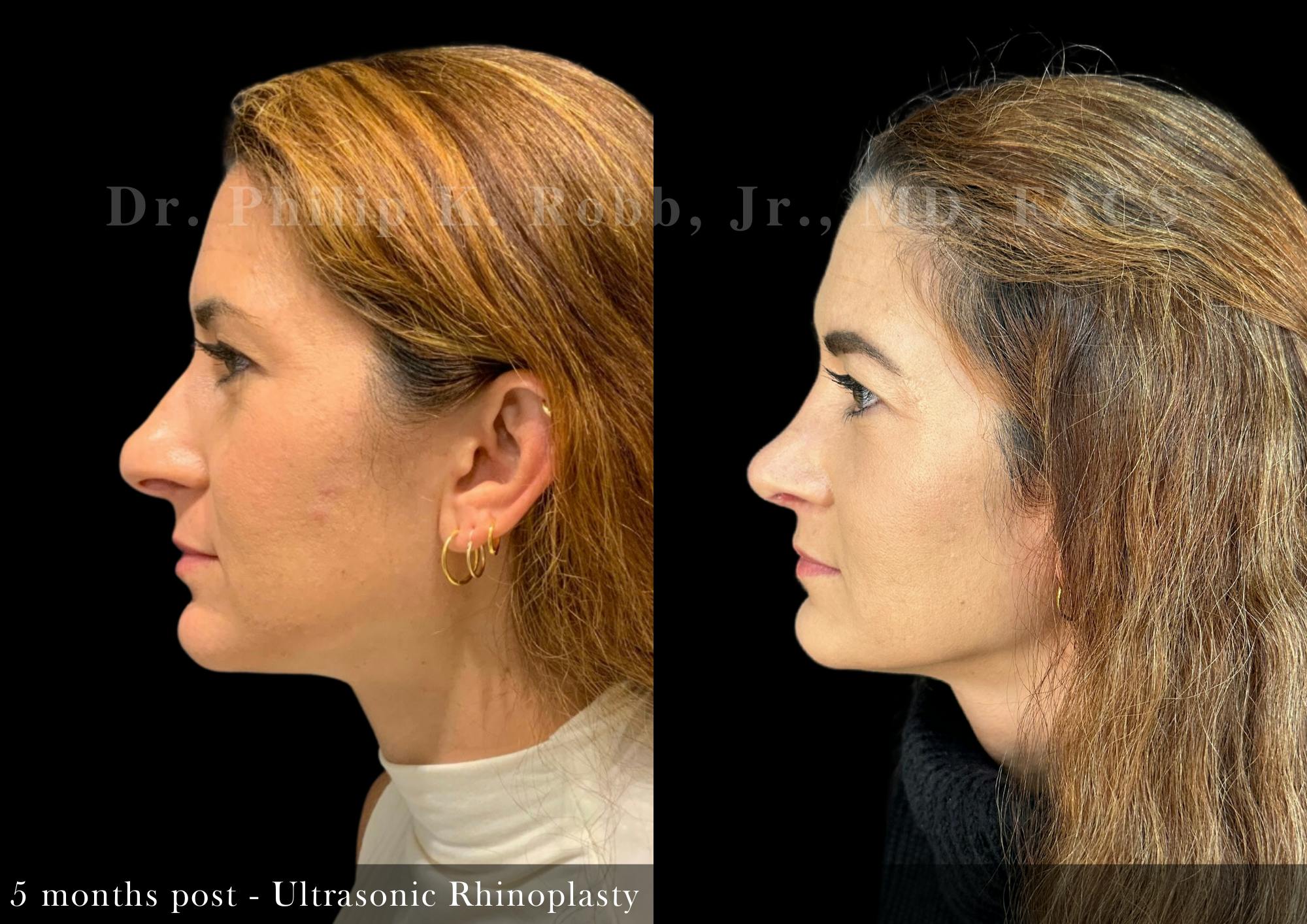 Nose Before & After Gallery - Patient 485237 - Image 5