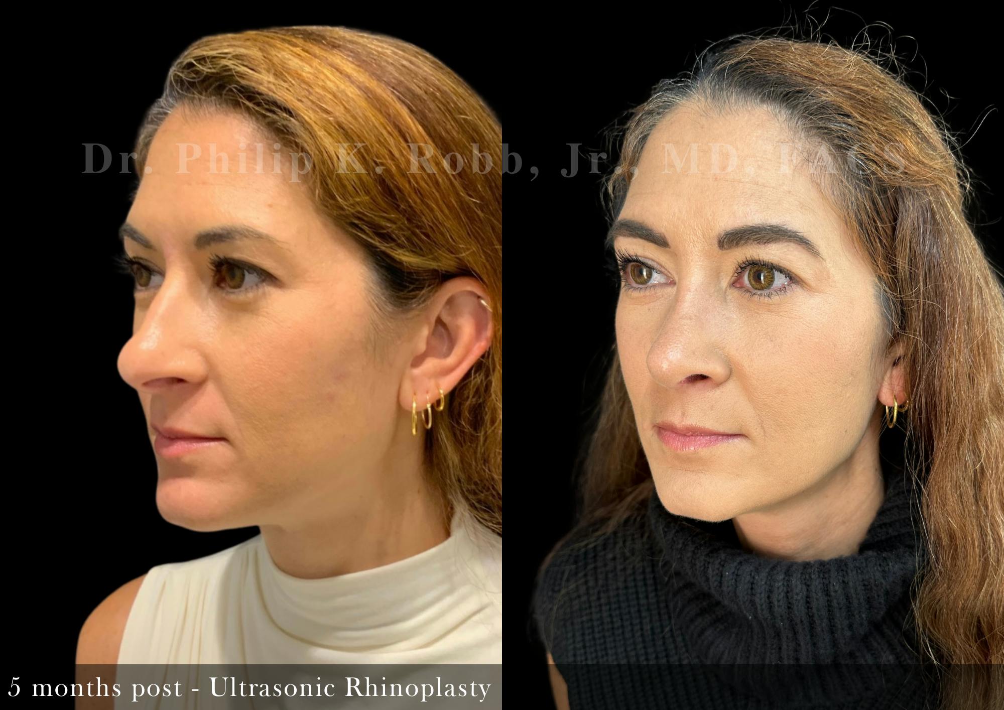 Nose Before & After Gallery - Patient 485237 - Image 4
